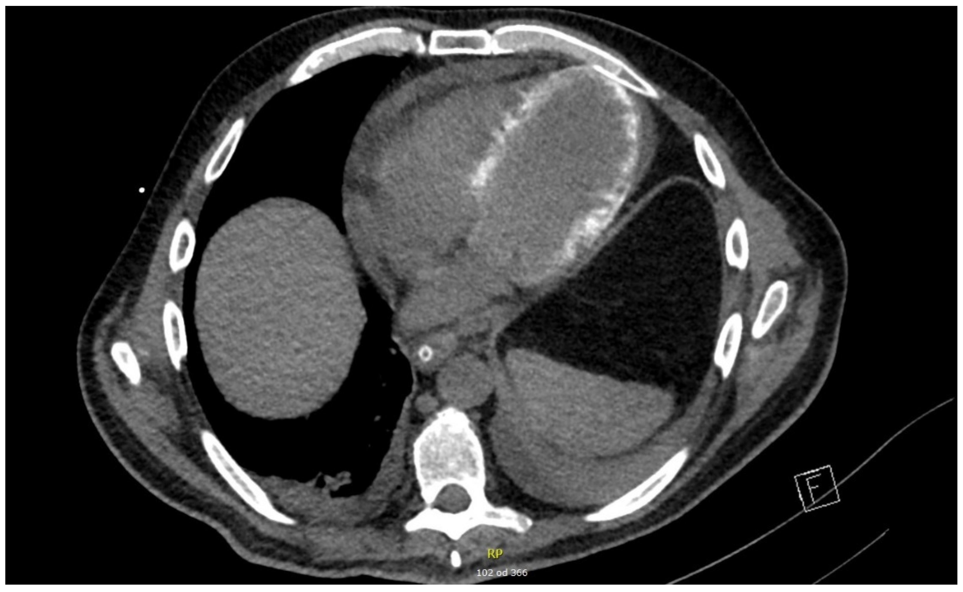 A Patient with Severe Leptospirosis Treated with Cytokine Removal and ...