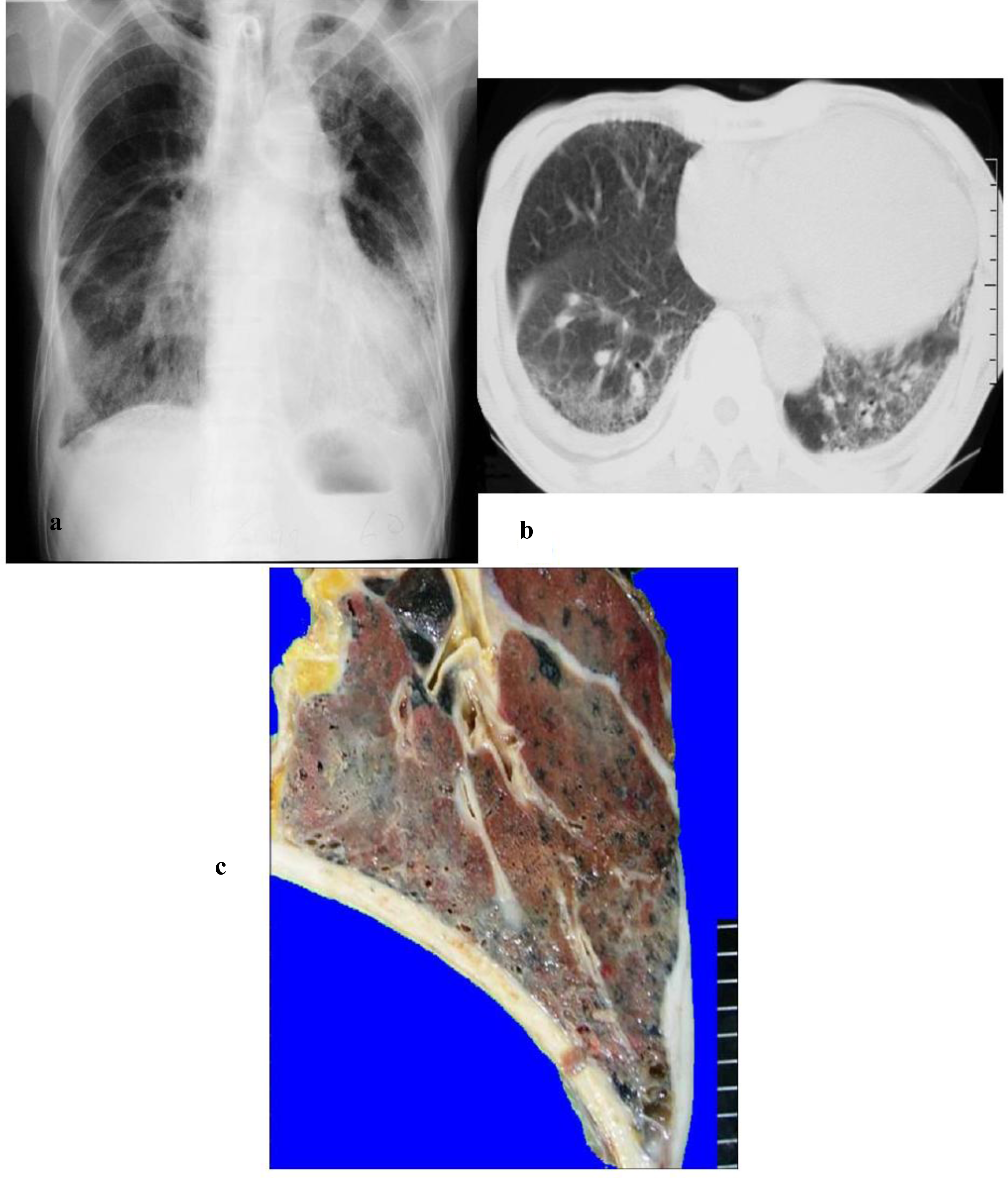 Clinical, Radiological, and Pathological Investigation of