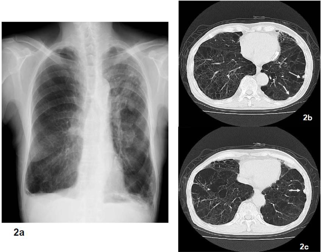 mesothelioma nsw