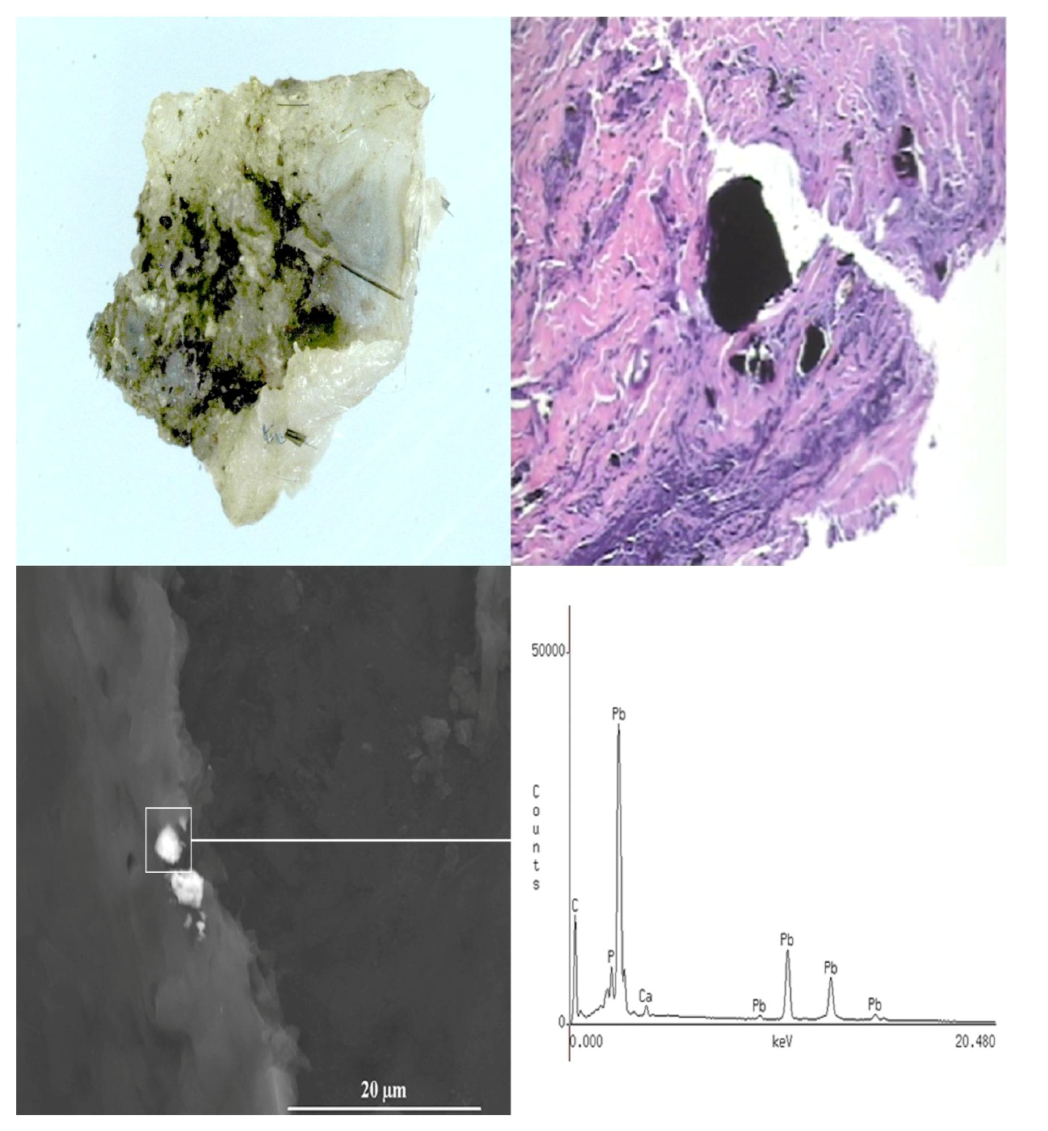 white tan tissue fragments meaning white tan tissue fragments meaning