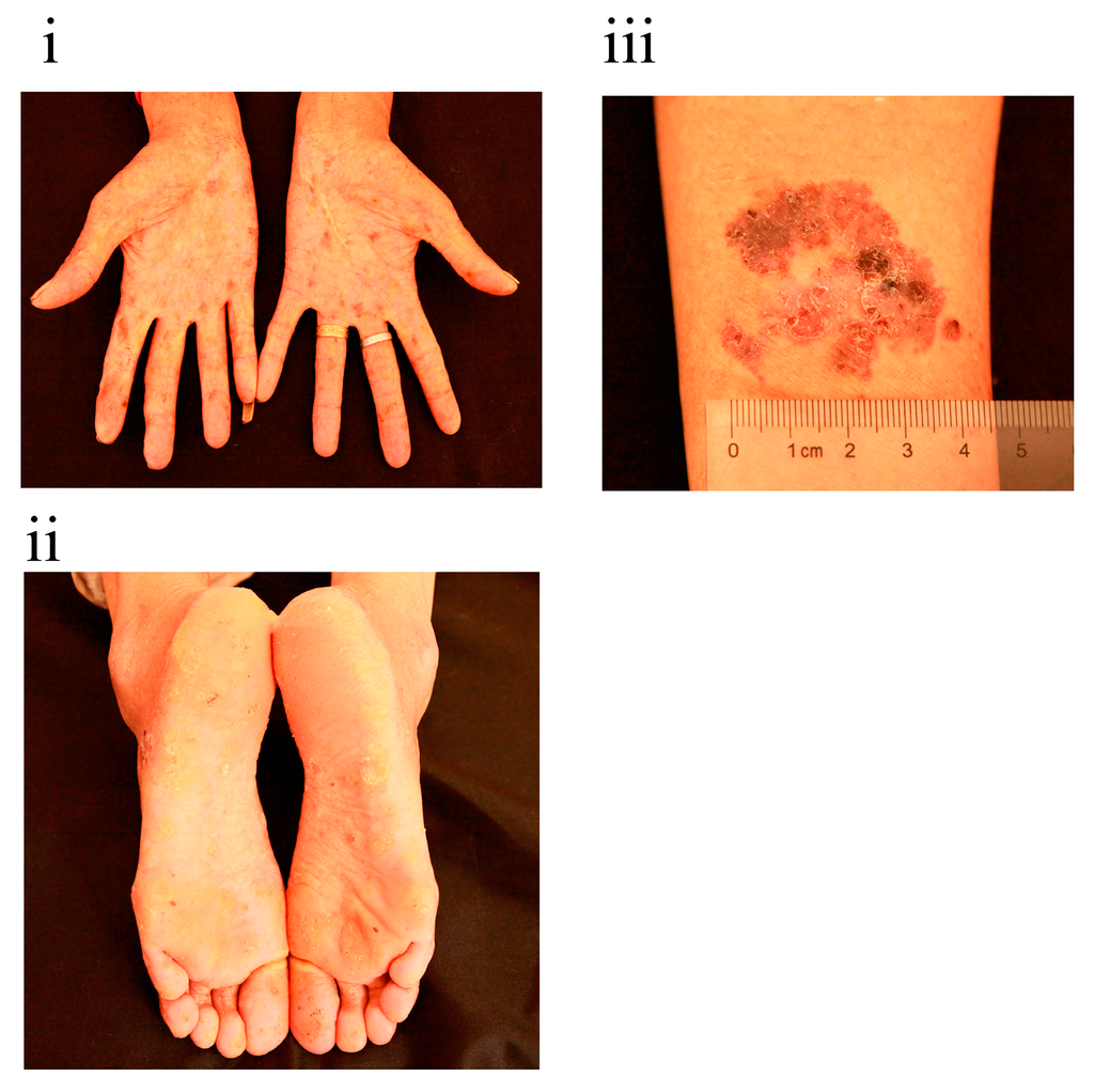 Palmoplantar Eruption in a Patient With Mercury Poisoning | MDedge  Dermatology