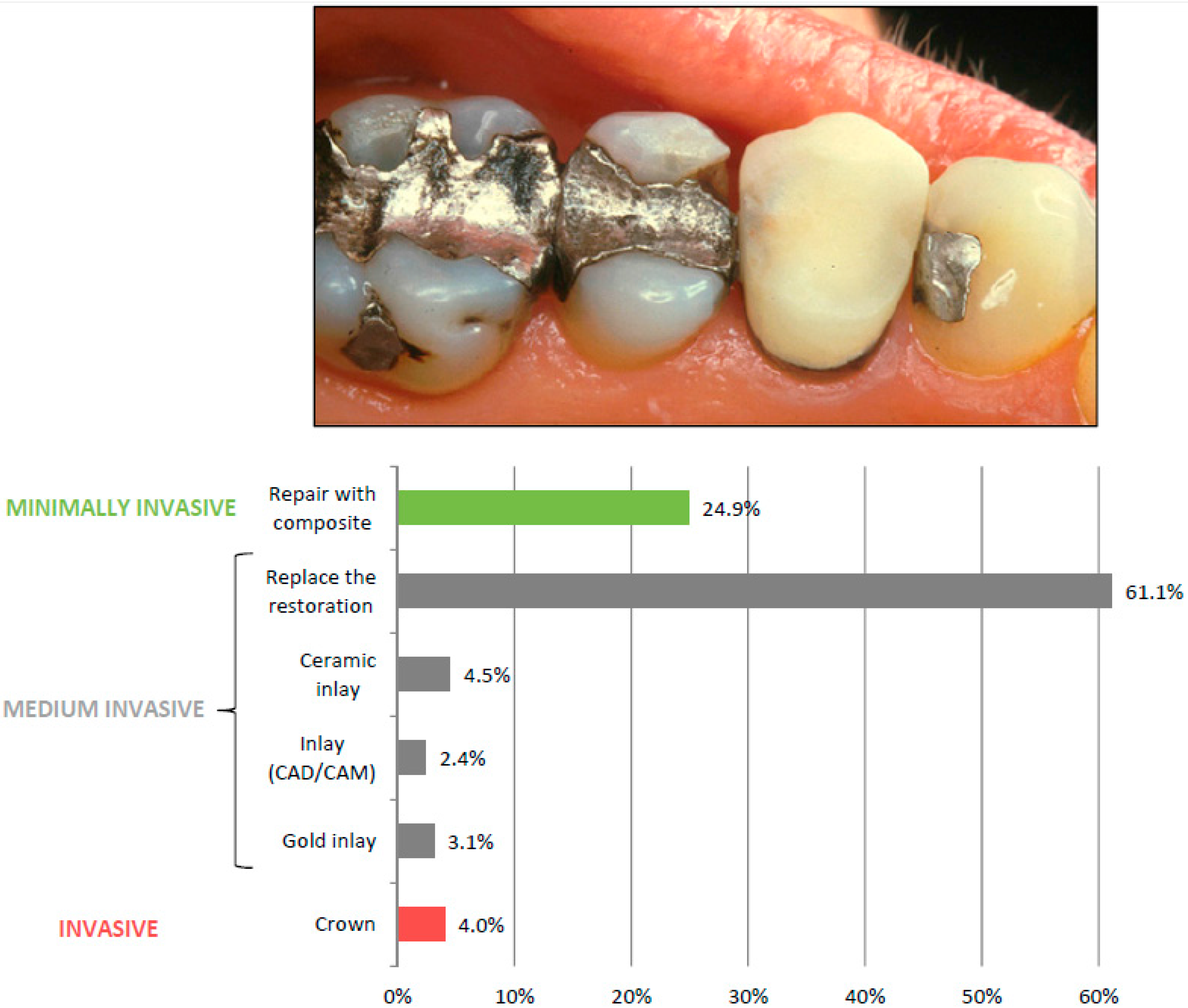 Dental 5-Stage Endodontic Treatment Model Caries of Premolars Endodontic Restoration Teeth Model for Study Teach Teeth Dental Supplies
