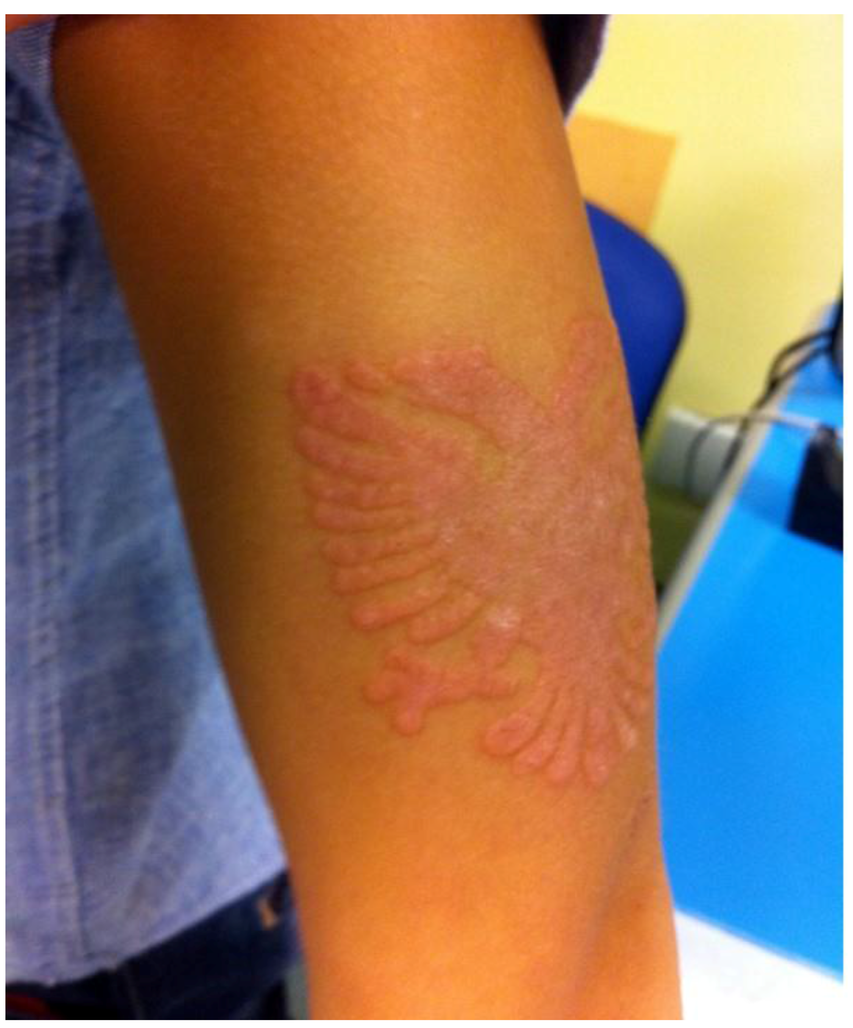 IJERPH | Free Full-Text | Temporary Black Henna Tattoos and Sensitization  to para-Phenylenediamine (PPD): Two Paediatric Case Reports and a Review of  the Literature