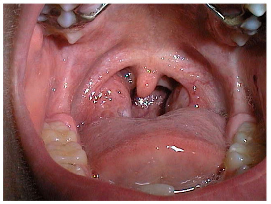 tonsillar hypertrophy score