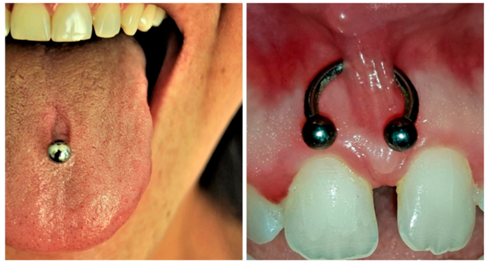 Risks of oral piercings - Clínica Pardiñas