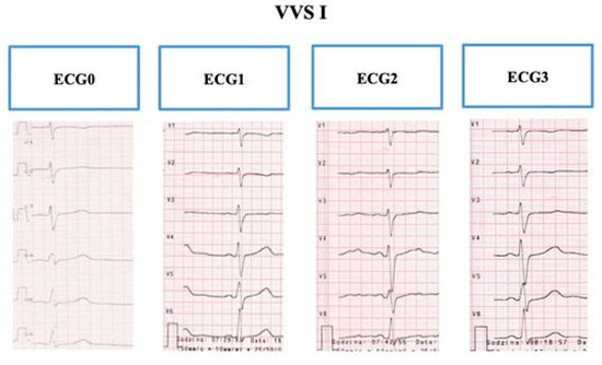 Ijerph Free Full Text The Repolarization Period During The Head Up Tilt Test In Children With Vasovagal Syncope Html