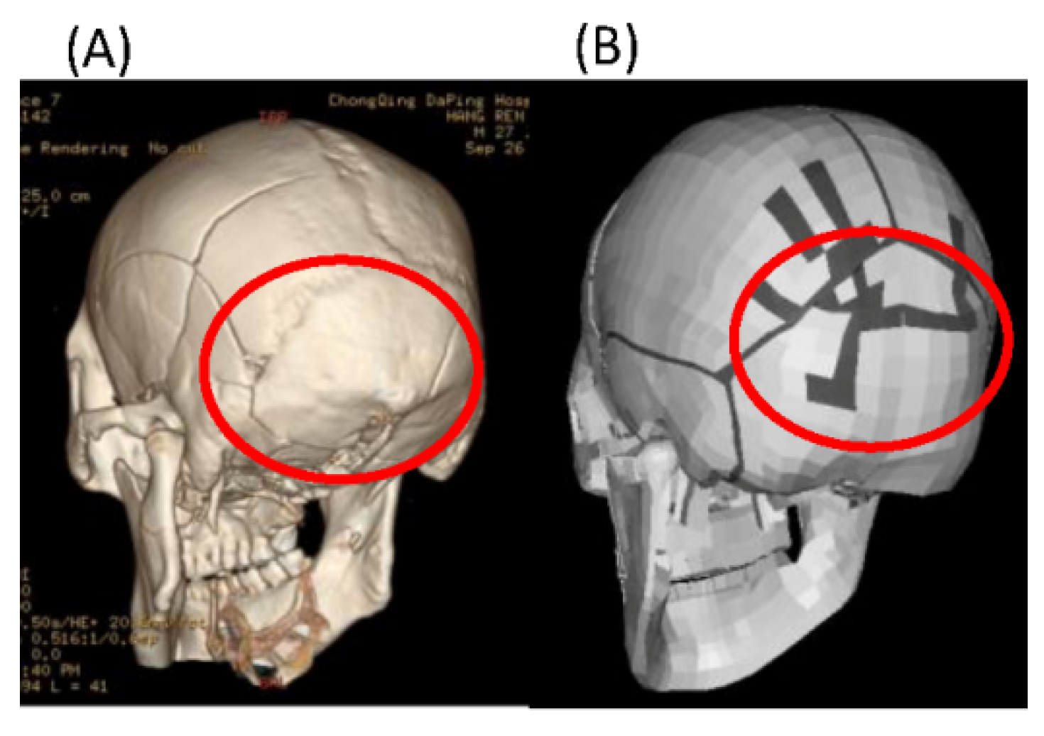 skull fracture signs skull fracture signs