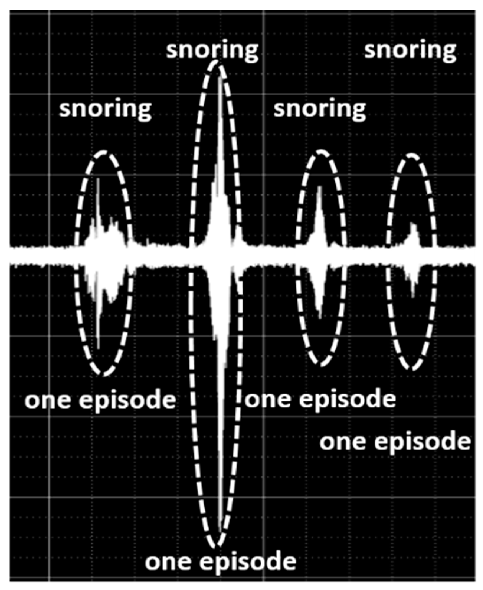 IJERPH | Free Full-Text | A New Feature with the Potential to Detect the  Severity of Obstructive Sleep Apnoea via Snoring Sound Analysis