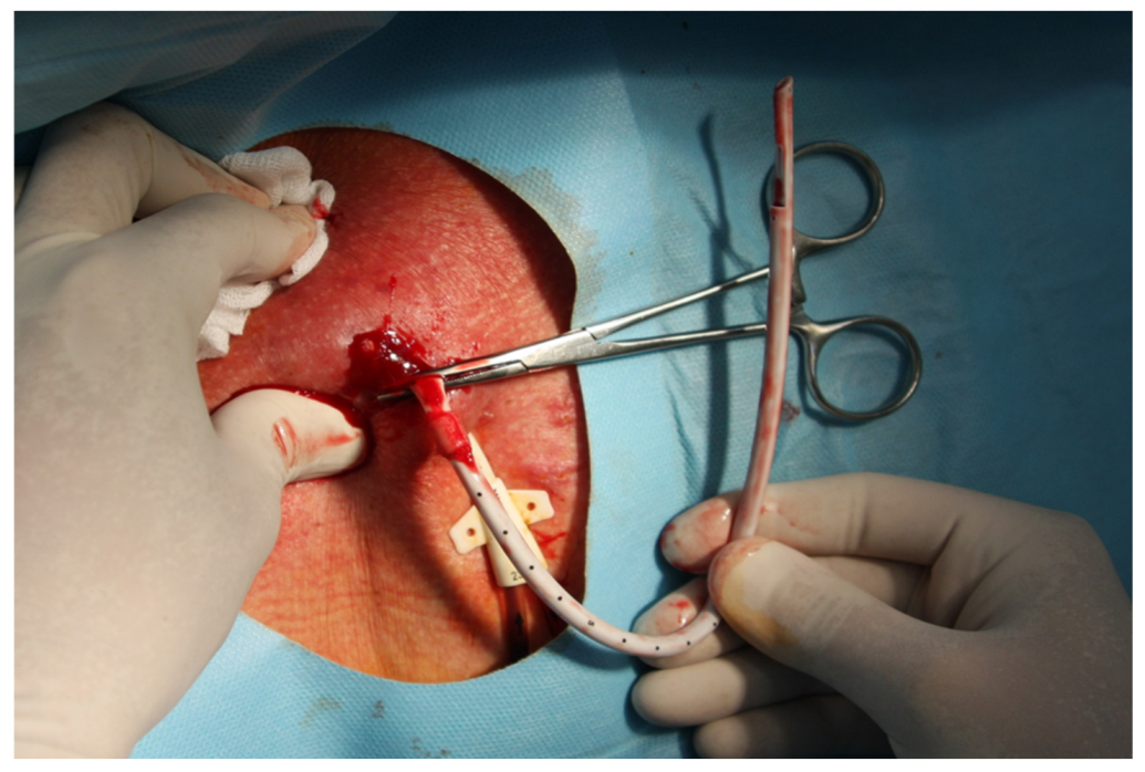 Ijerph Free Full Text Tunnelled Haemodialysis Catheter Removal An Underreciated Problem Not Always Simple And Safe Ijerph Free Full Text Tunnelled