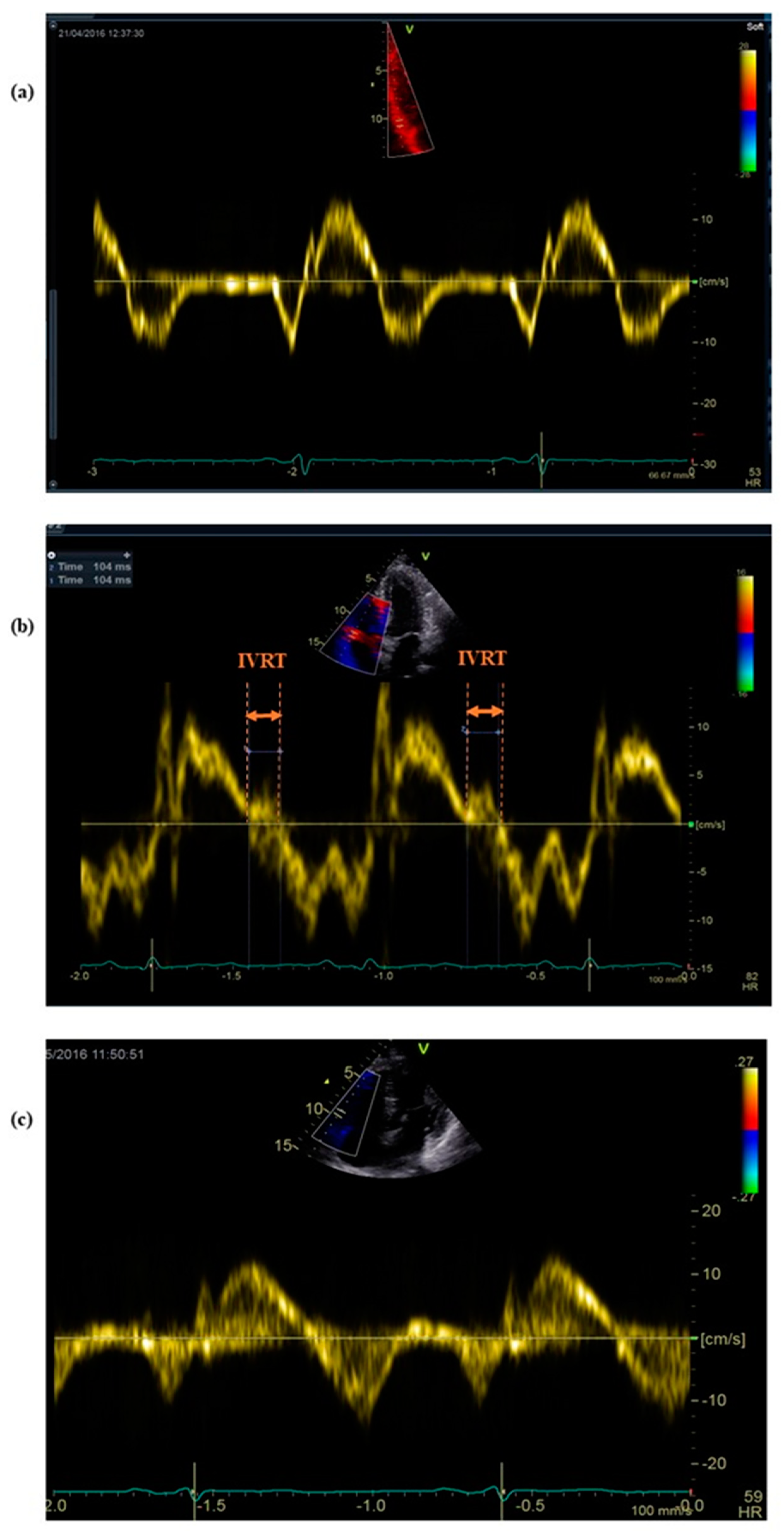 Ijerph Free Full Text Right Ventricular Diastolic Dysfunction After Marathon Run Ijerph Free Full Text Right Ventricular Diastolic Dysfunction After Marathon Run