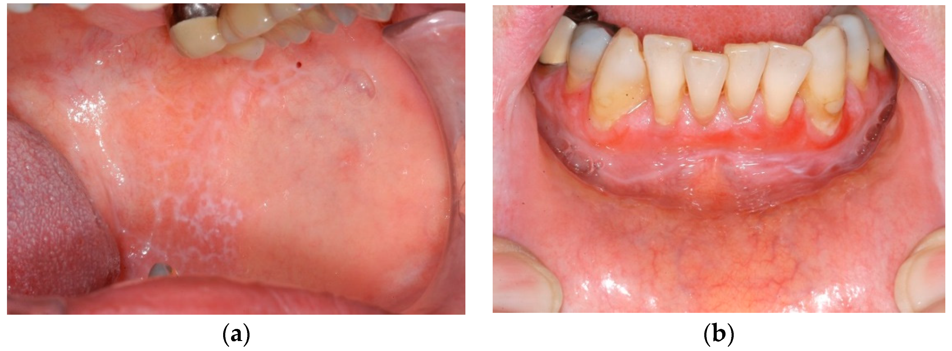 Ijerph Free Full Text Does The Clinical Form Of Oral Lichen Planus Olp Influence The Oral Health Related Quality Of Life Ohrqol Html