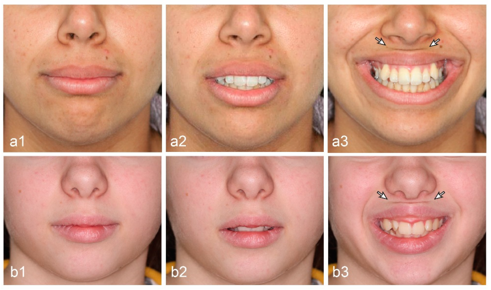 Lines and Wrinkles on the Upper Lip and Around the Mouth Explained – Caci