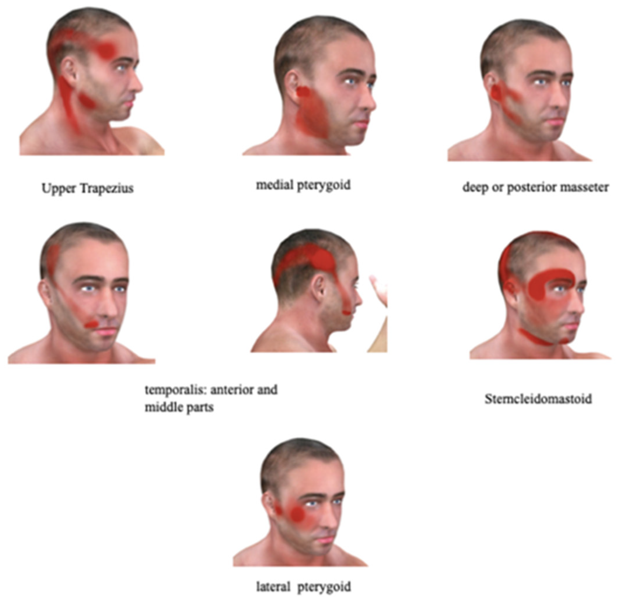 Atypical Facial Pain