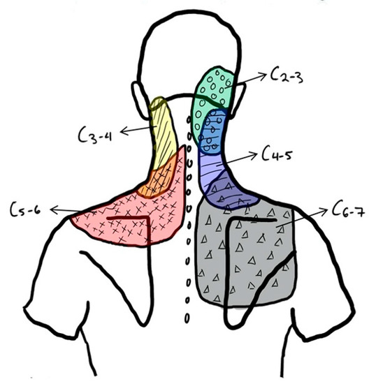 IJERPH Free FullText Medial Branch Blocks for Diagnosis of Facet
