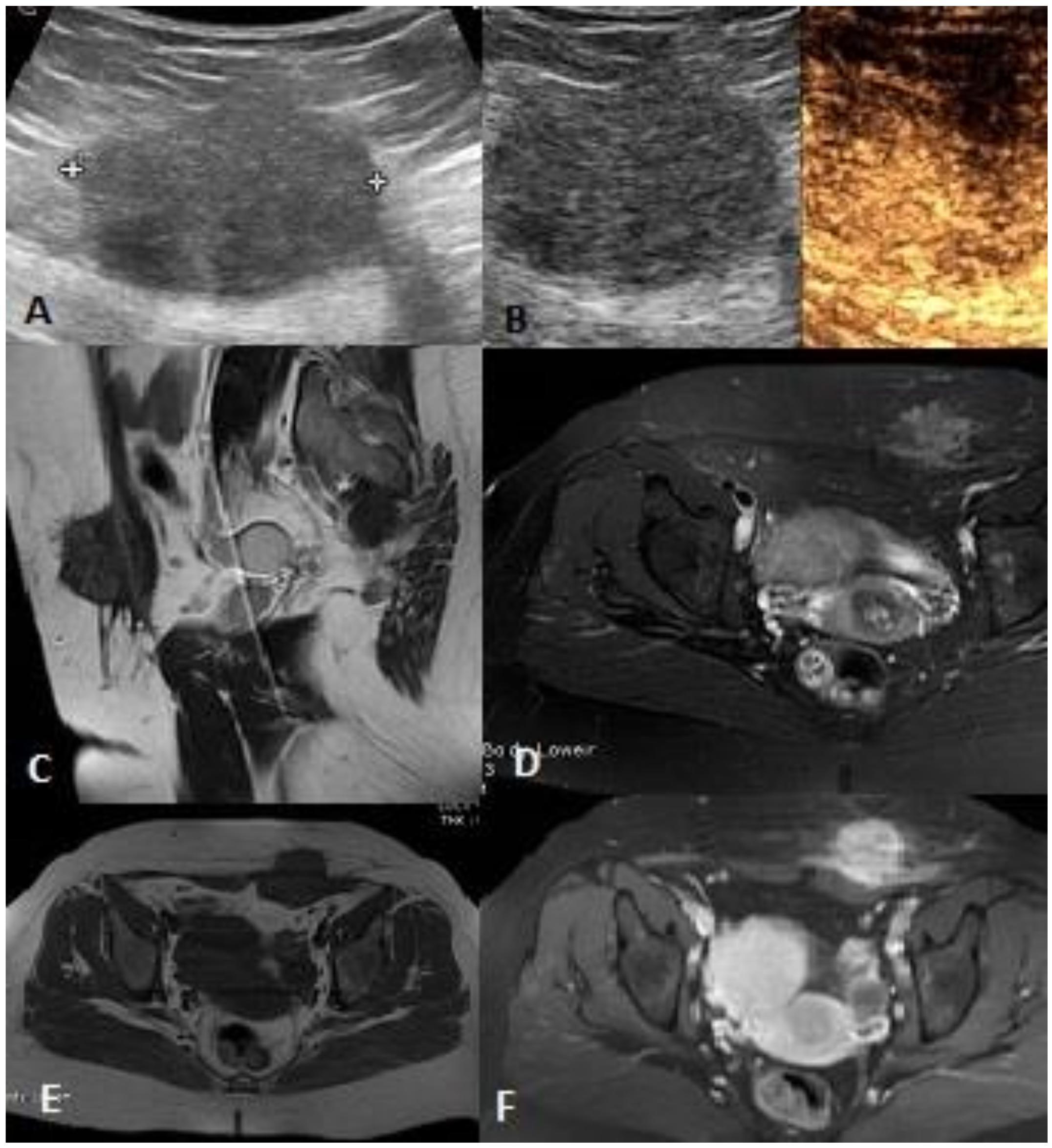 Soft, symmetrical, bulky tumors on the back