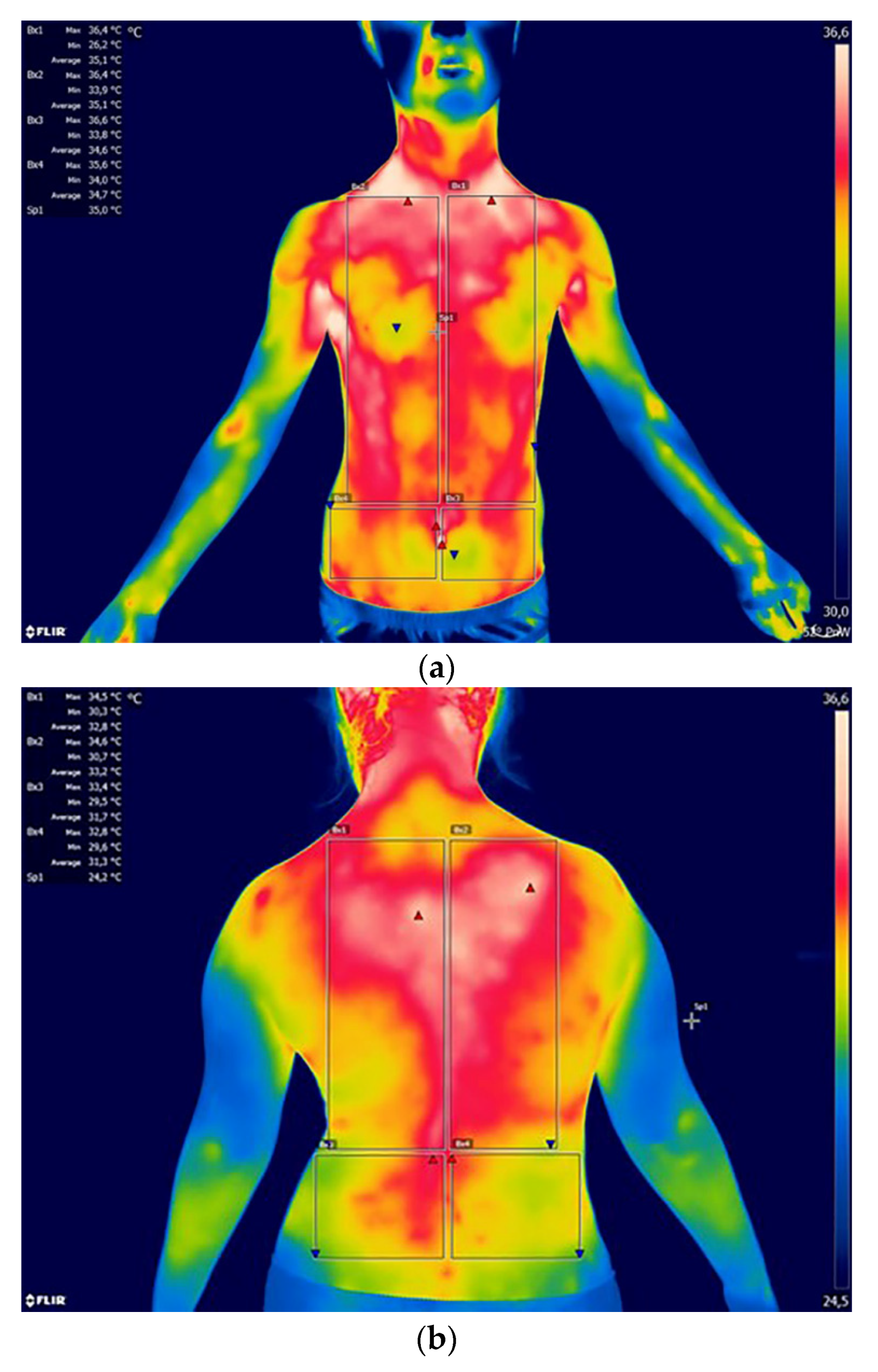 Relevance of low-pressure compression corsets in physiotherapeutic