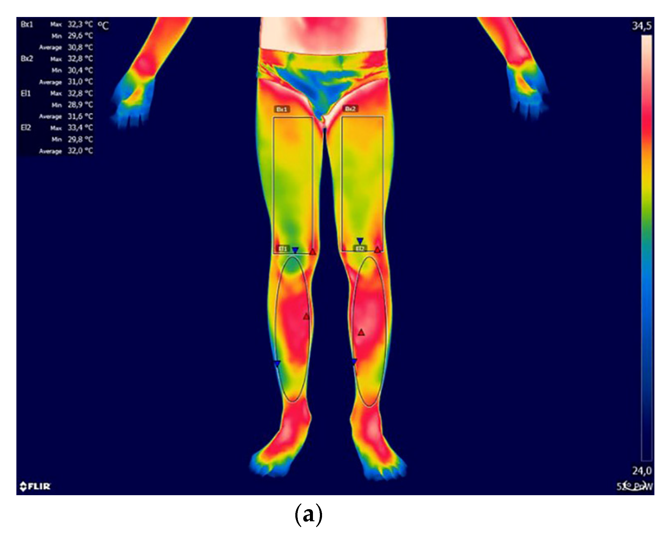 Ijerph Free Full Text Temperature Distribution Of Selected Body Surfaces In Scoliosis Based On Static Infrared Thermography Html Ijerph Free Full Text Temperature Distribution Of Selected Body Surfaces In Scoliosis Based On Static Infrared Thermography Html