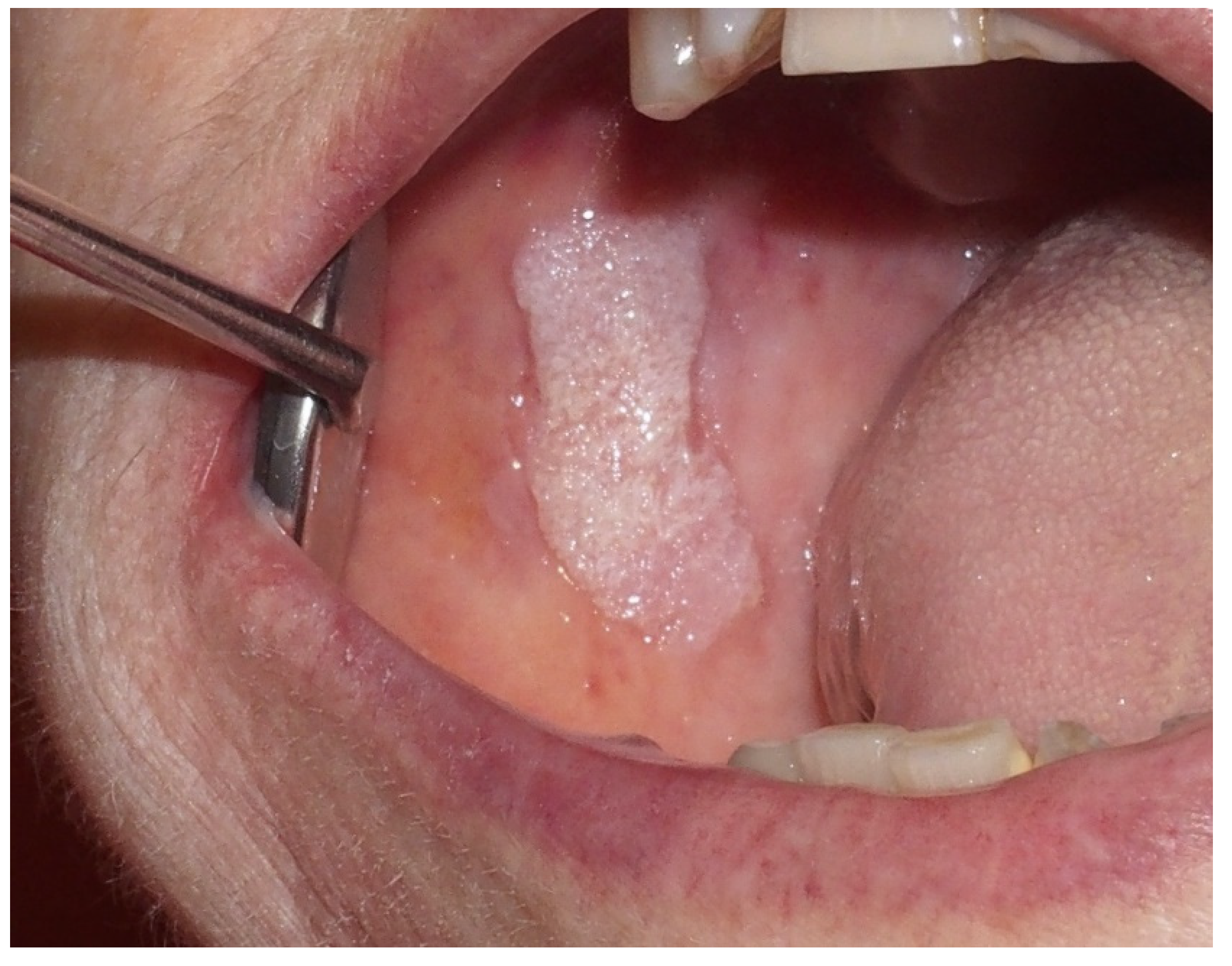 verrucous carcinoma palate