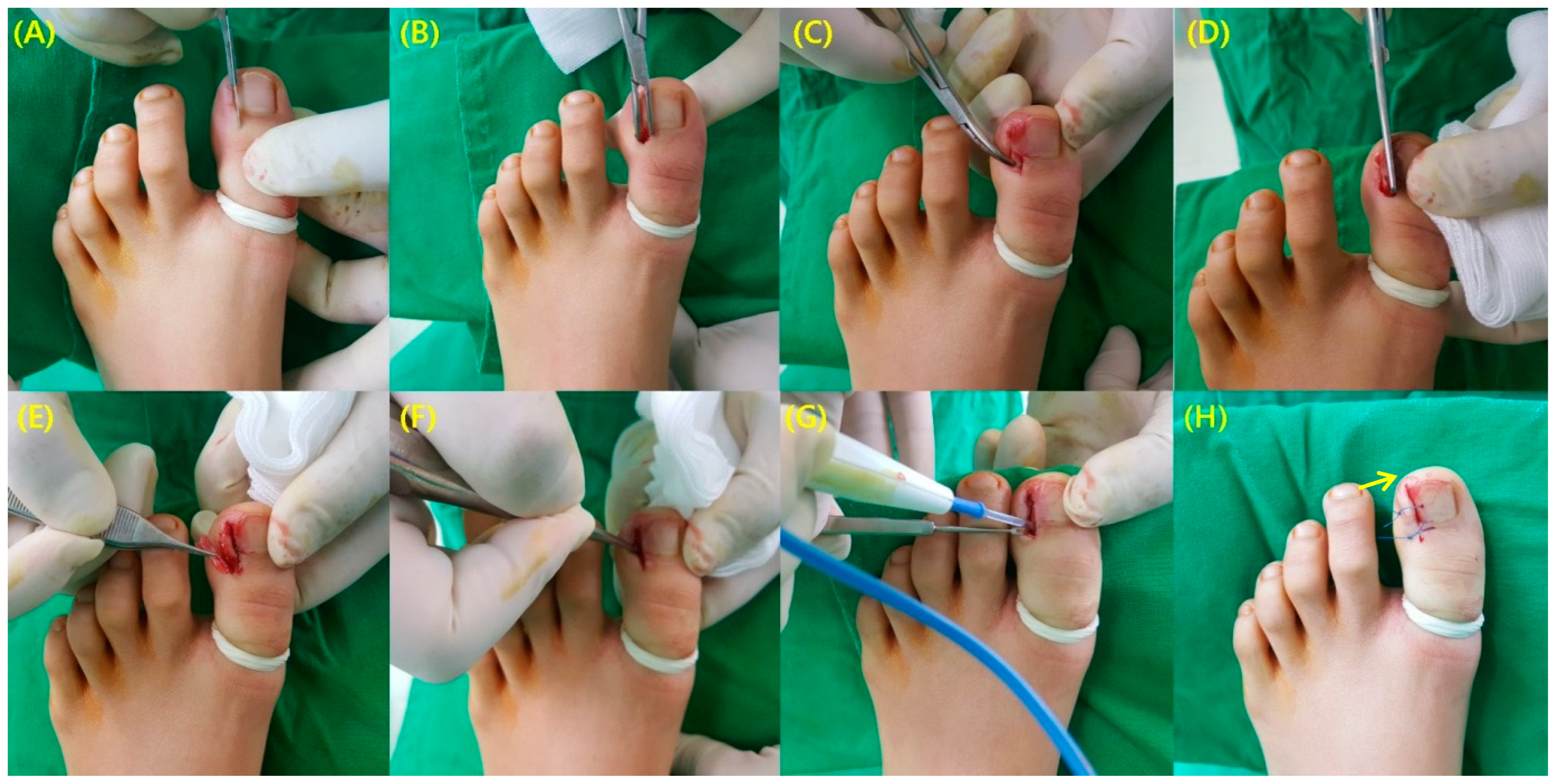 Toenail surgery | Kent Community Health NHS Foundation Trust