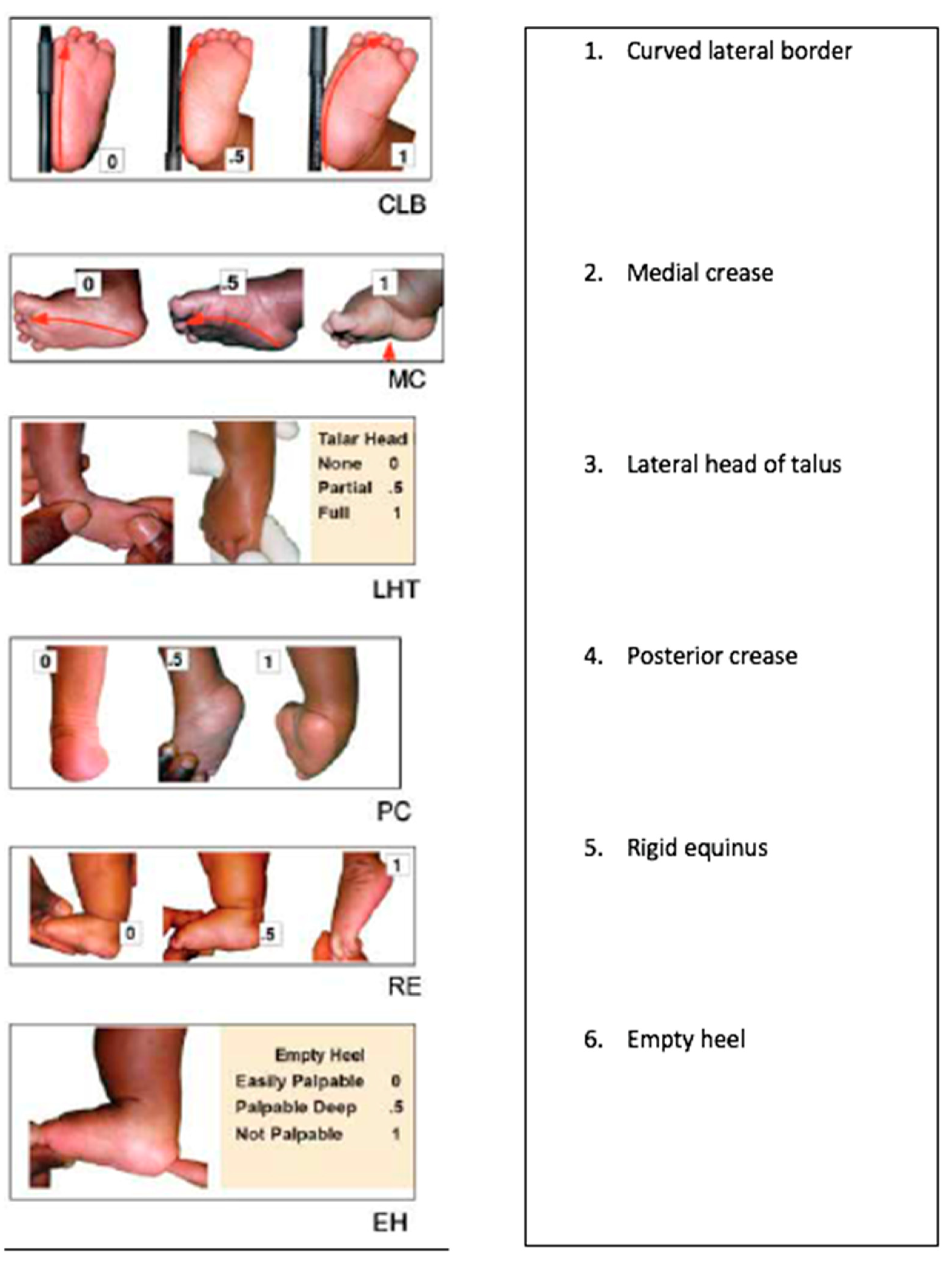 Ijerph Free Full Text A Community Audit Of 300 Drop Out Instances In Children Undergoing Ponseti Clubfoot Care In Bangladesh What Do The Parents Say Html