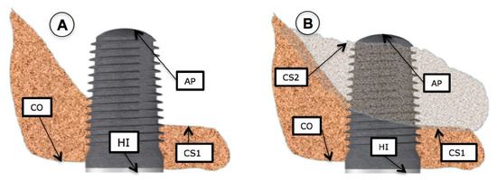 Sinus Floor Elevation via an Osteotome Technique without Biomaterials
