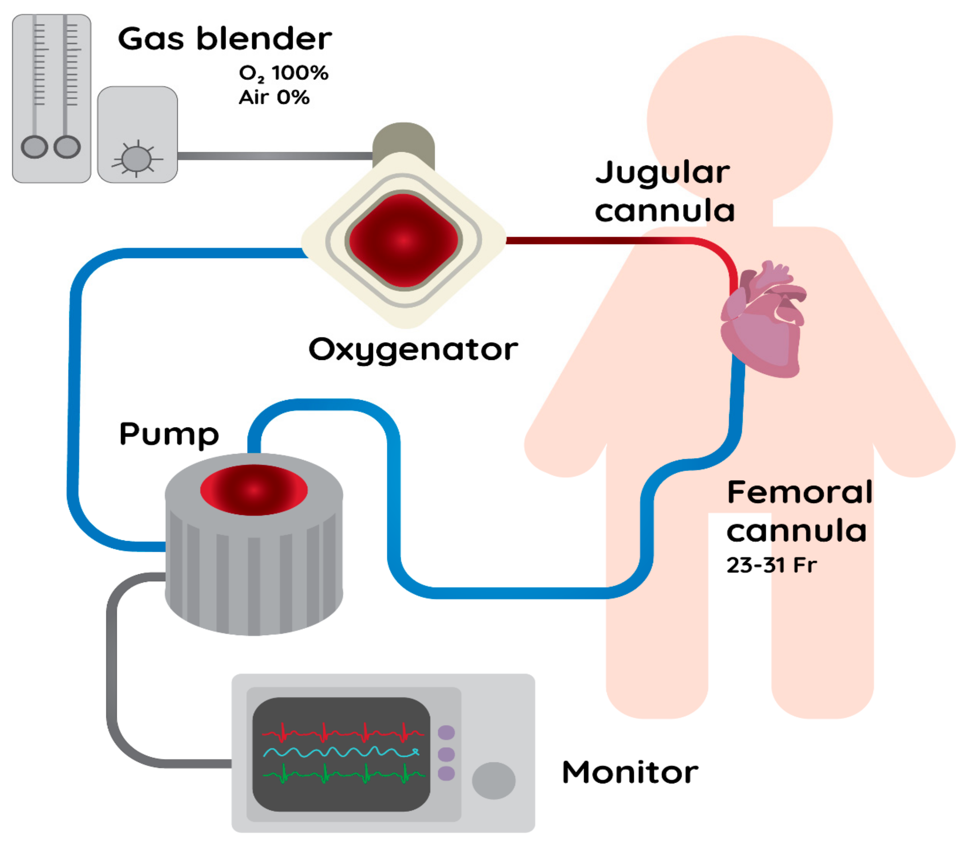 IJERPH Free FullText VenoVenous Extracorporeal Membrane