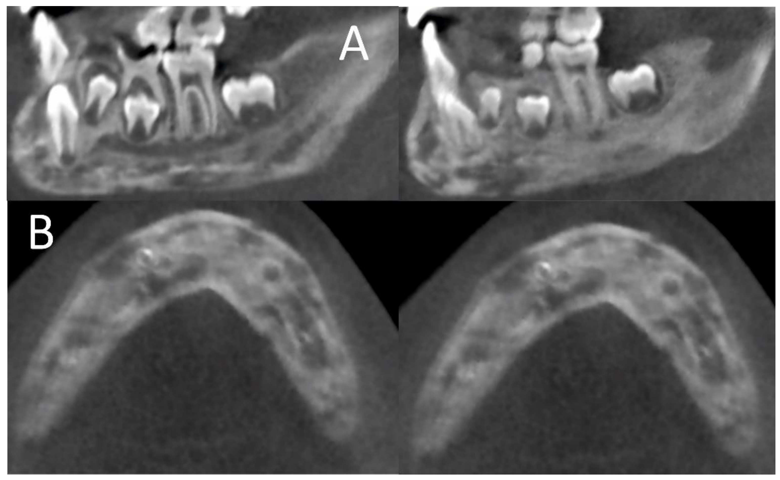 IJERPH Free FullText An Orthodontic Approach for Garre’s