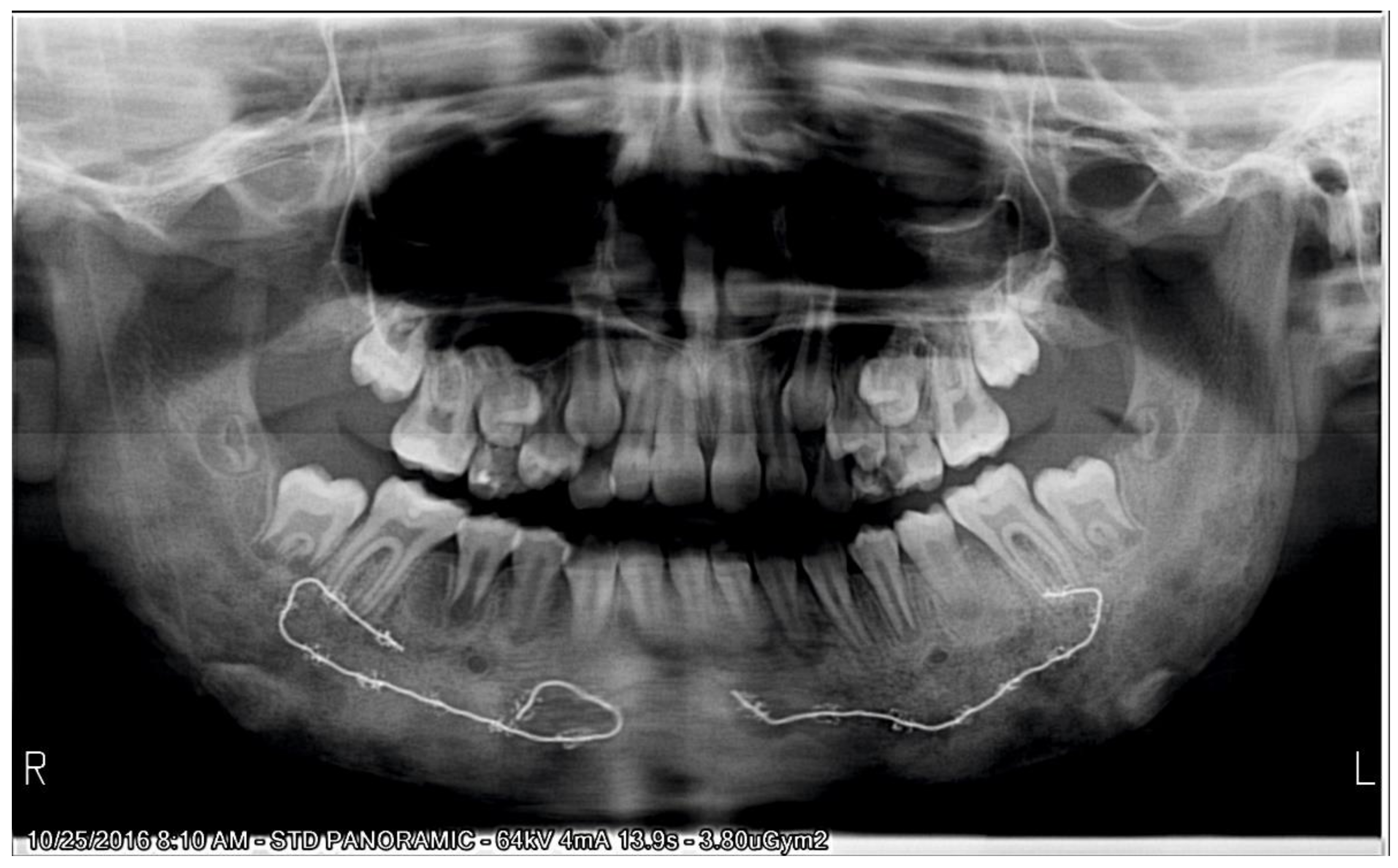 IJERPH Free FullText An Orthodontic Approach for Garre’s
