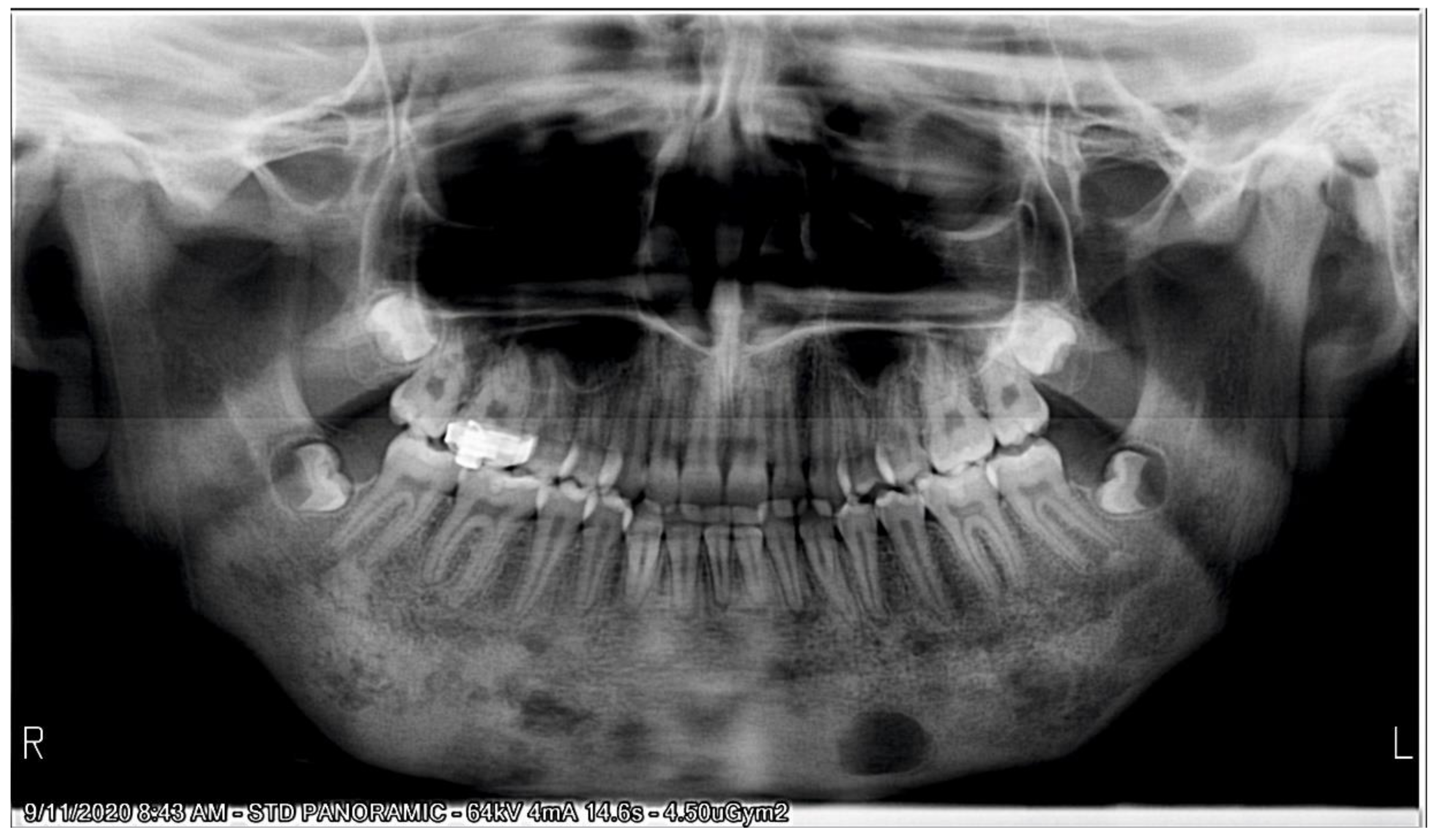IJERPH Free FullText An Orthodontic Approach for Garre’s