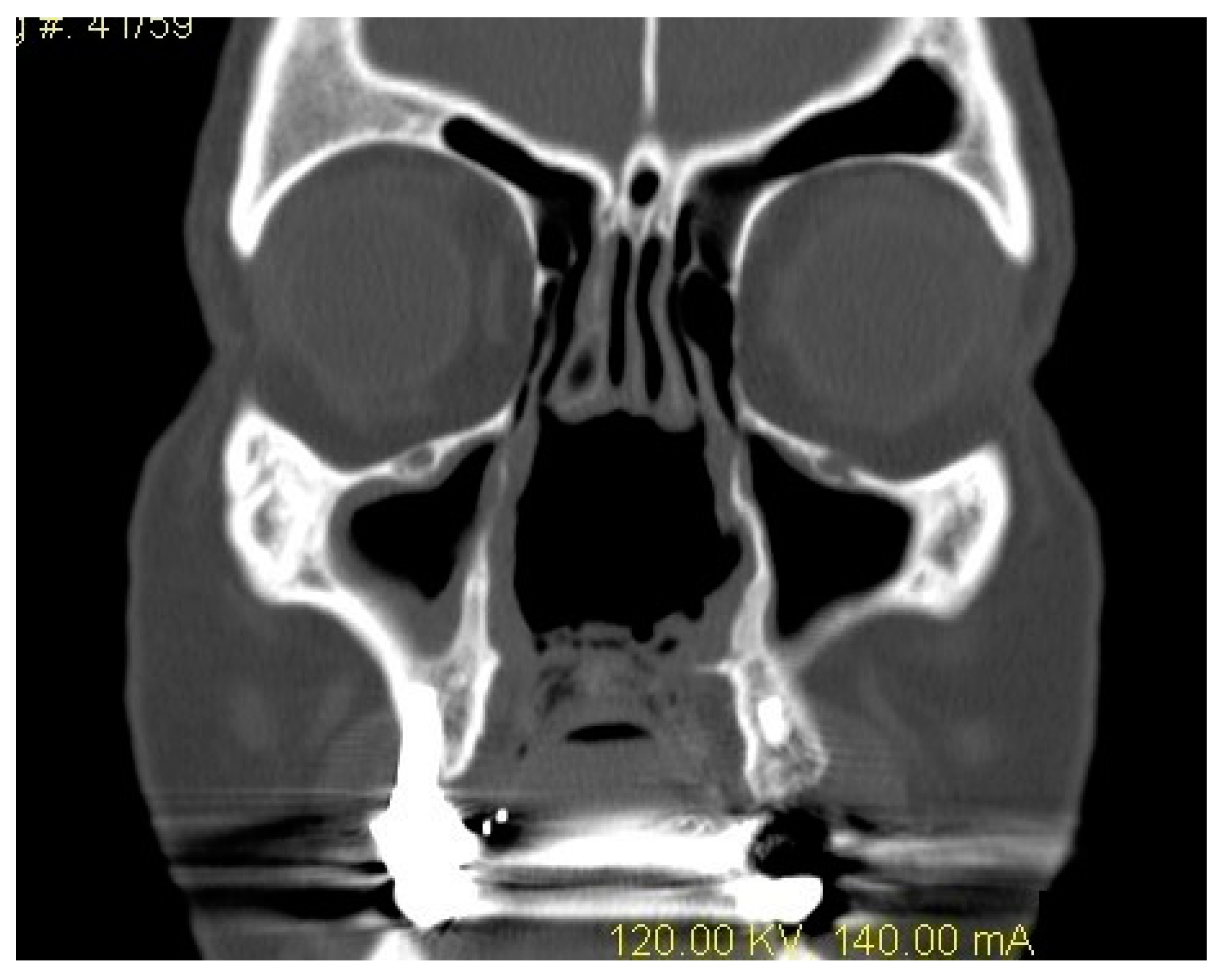 Spicy Felling In Nose After Cocaine - 83ef9m3