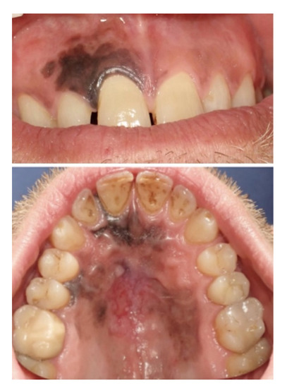 melanotic macule roof of mouth Mucosal Melanoma of the Hard Palate: Surgical Treatment and Reconstruction