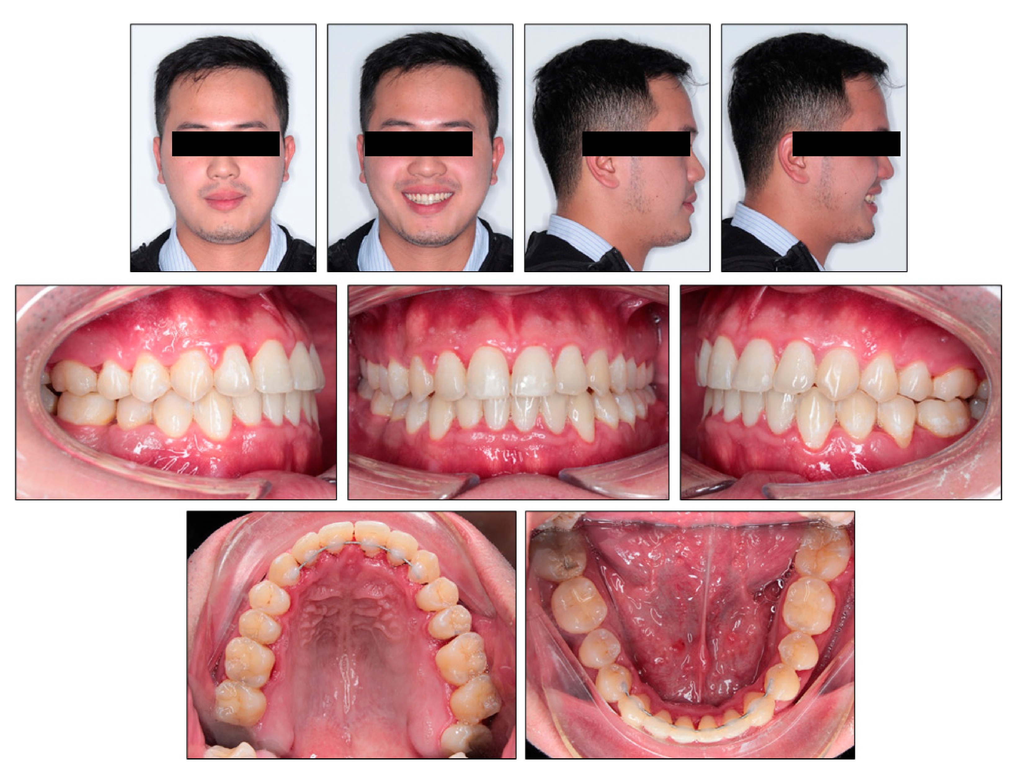 class iii malocclusion treatment options