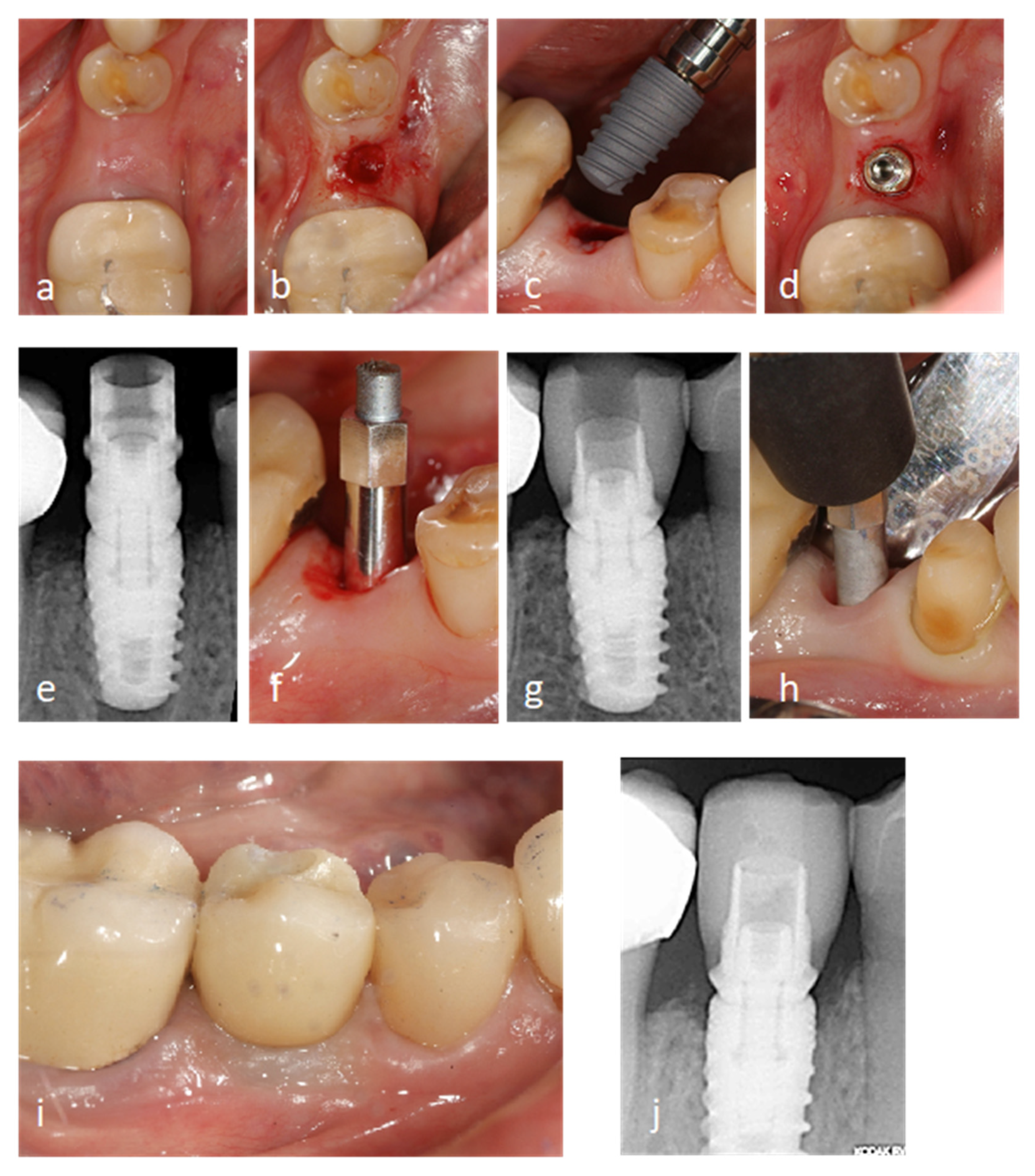 Dental implants: Mandibular neurovascular considerations 