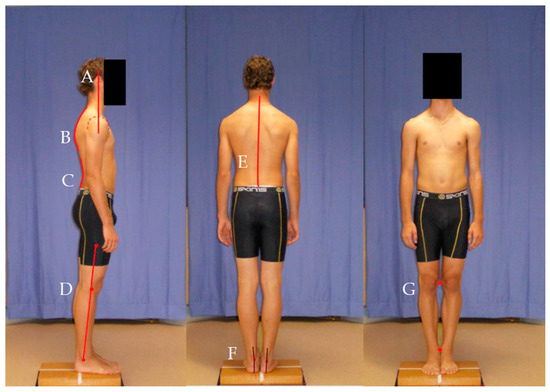 IJERPH Free Full-Text Relationship between Posture and Non-Contact Lower Limb Injury in Young Male Amateur Football Players A Prospective Cohort Study