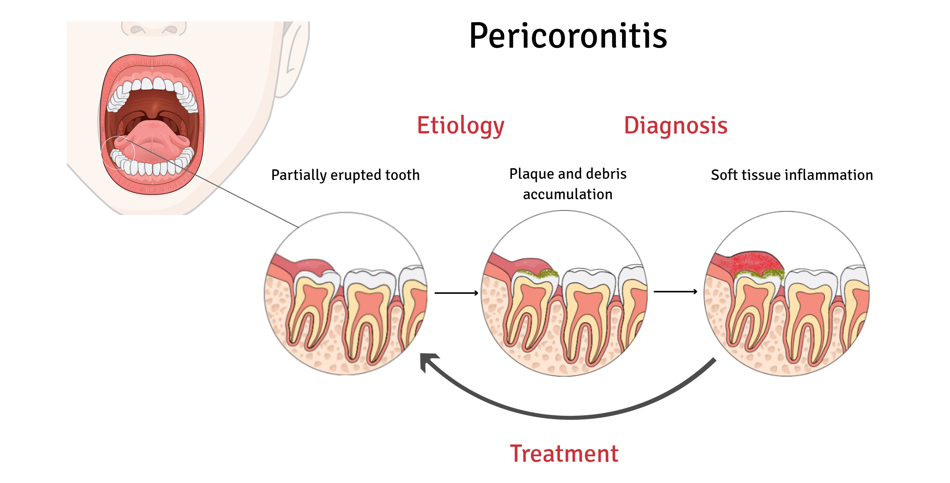 Ijerph Free Full Text A Review Of Evidence Based Recommendations For Pericoronitis Management And A Systematic Review Of Antibiotic Prescribing For Pericoronitis Among Dentists Inappropriate Pericoronitis Treatment Is A Critical Factor Of Ijerph Free Full Text A Review Of Evidence Based Recommendations For Pericoronitis Management And A Systematic Review Of Antibiotic Prescribing For Pericoronitis Among Dentists Inappropriate Pericoronitis Treatment Is A Critical Factor Of