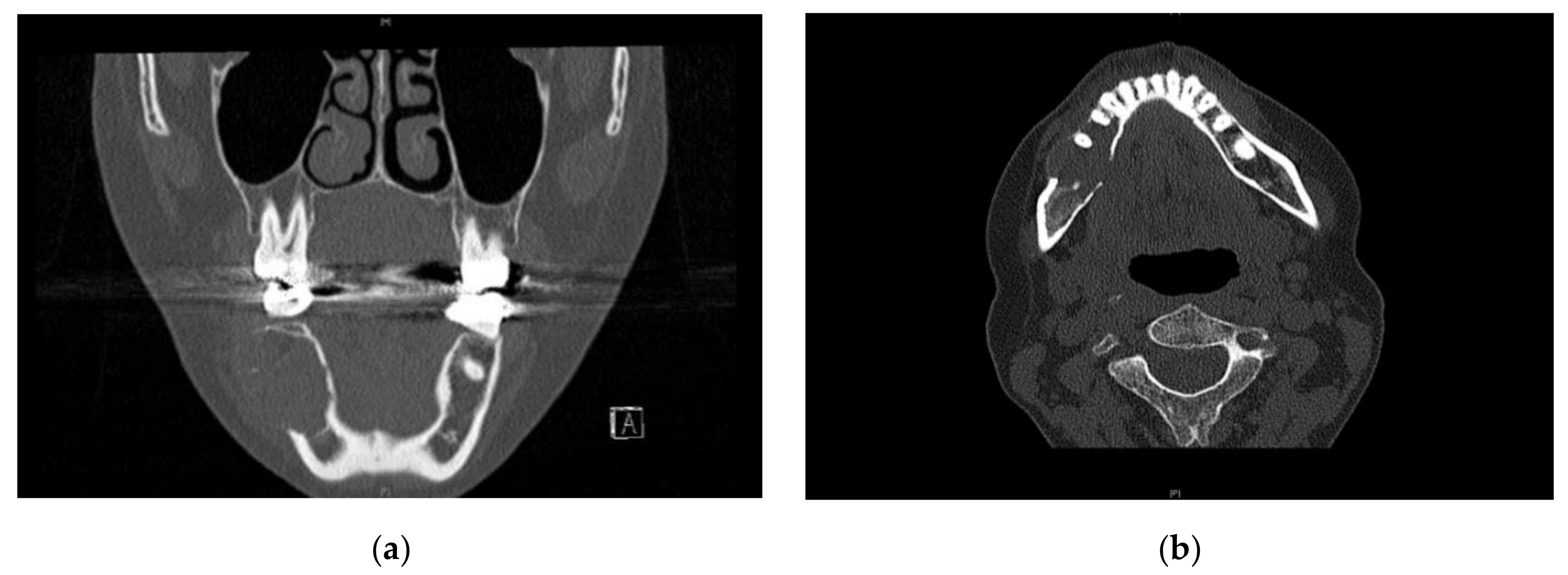 IJERPH | Free Full-Text | Mandibular Brown Tumor as a Result of Secondary  Hyperparathyroidism: A Case Report with 5 Years Follow-Up and Review of the  Literature