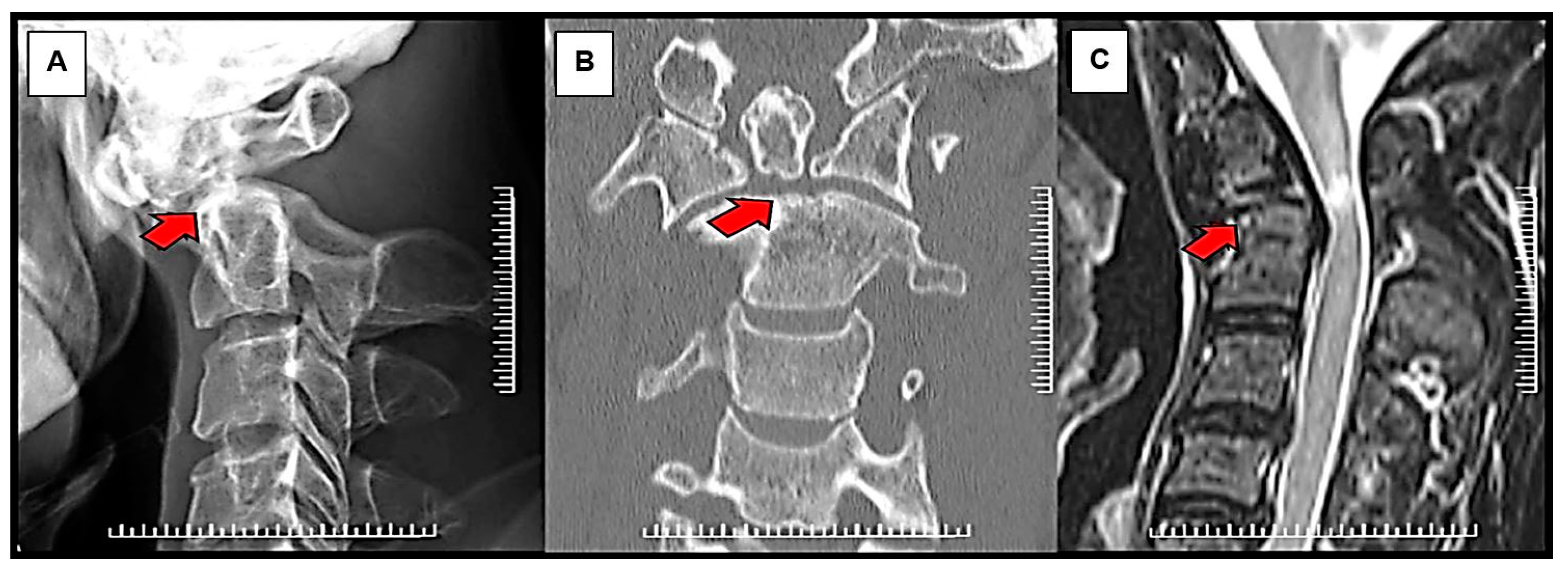 odontoid fracture type 1 odontoid fracture type 1