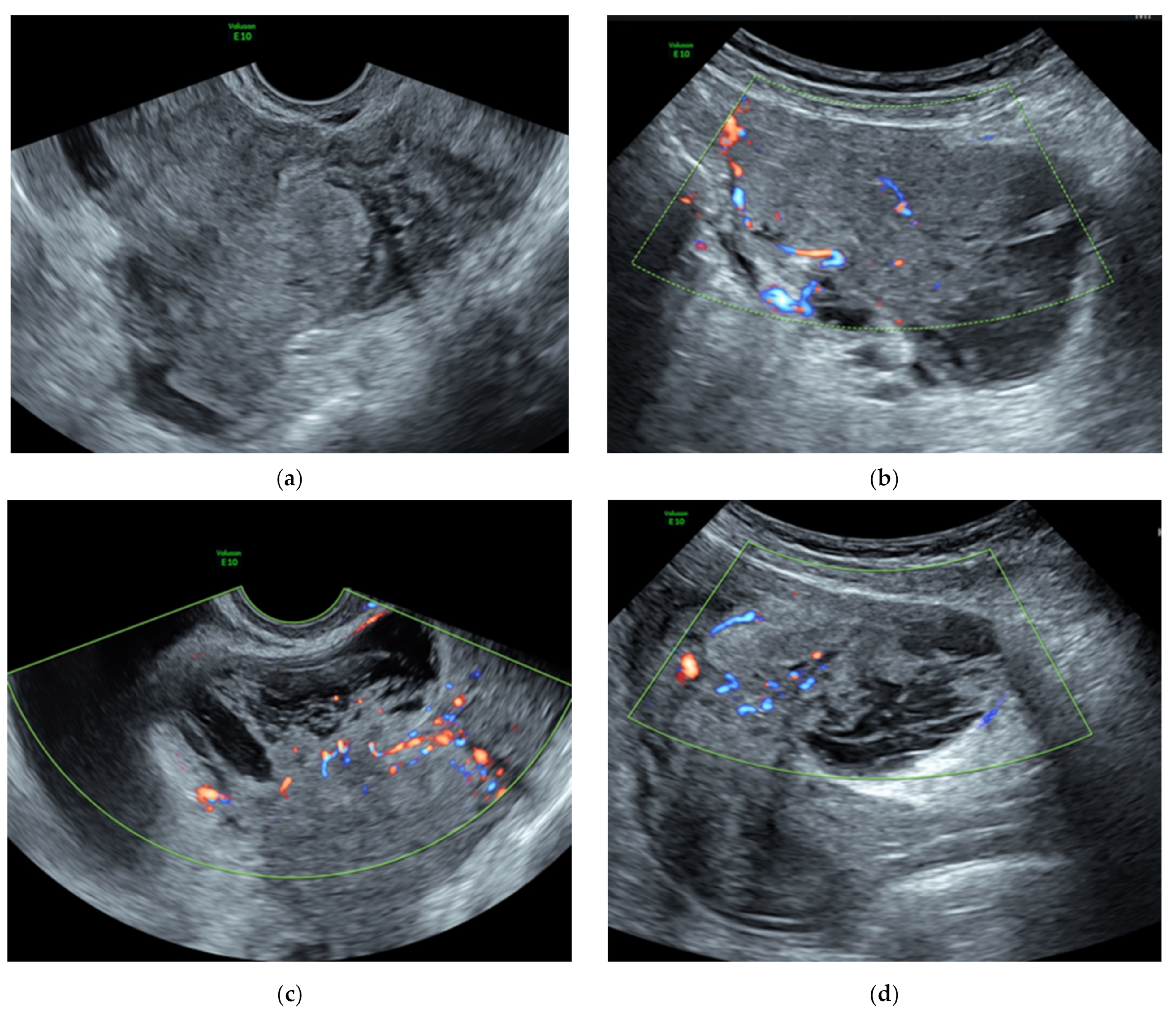 Ijerph Free Full Text The Management Of The Cotyledonoid Leiomyoma Of The Uterus A Narrative Review Of The Literature Html