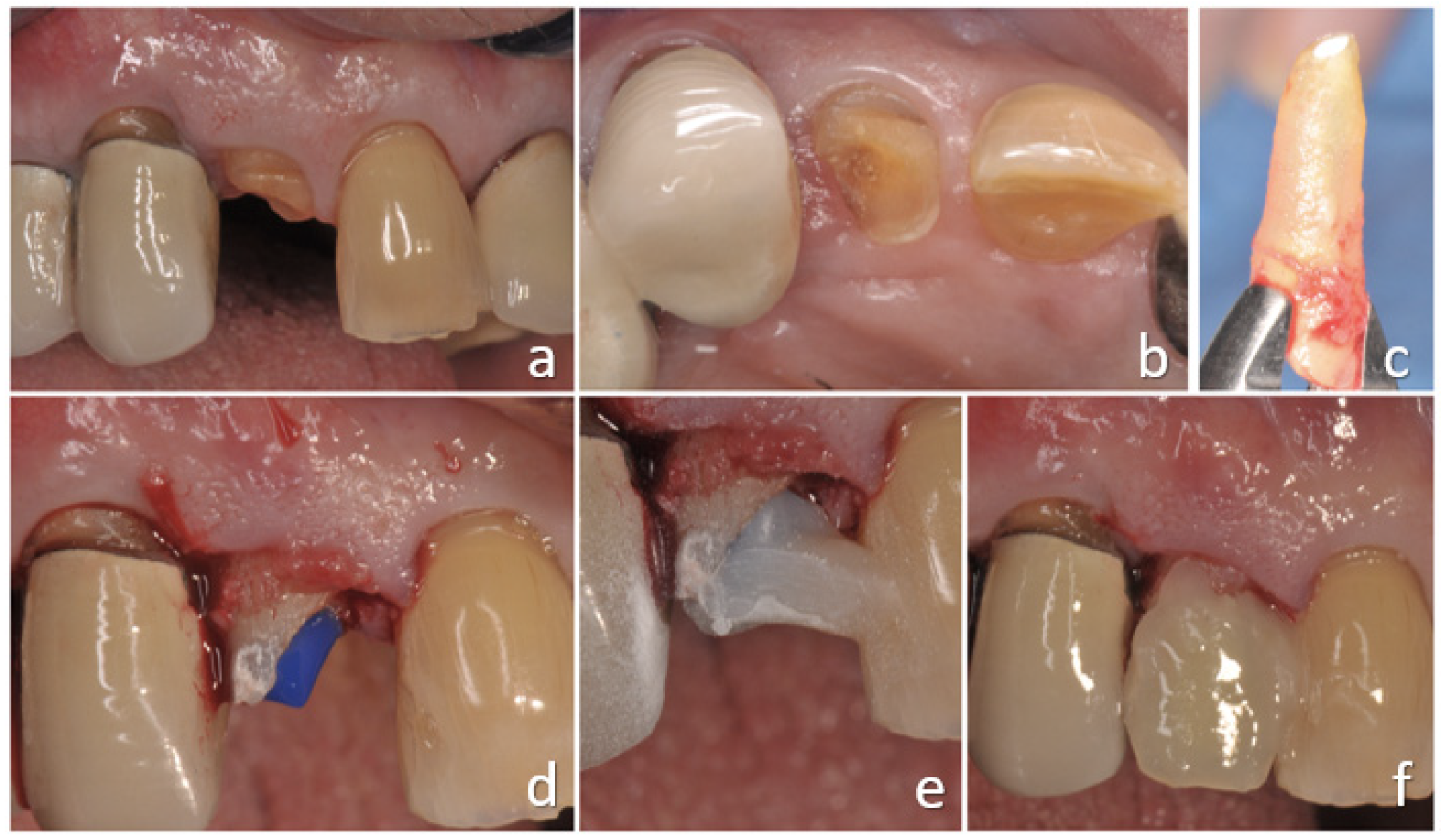 IJERPH | Free Full-Text | Orthodontic Extrusion vs. Surgical Extrusion to  Rehabilitate Severely Damaged Teeth: A Literature Review