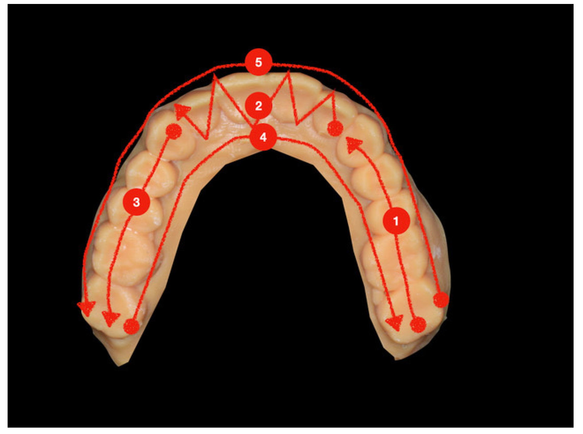 Nexus Scan Gauges and a validated intraoral scanner is all you need to  digitize your full-arch restoration workflow. When this data is…