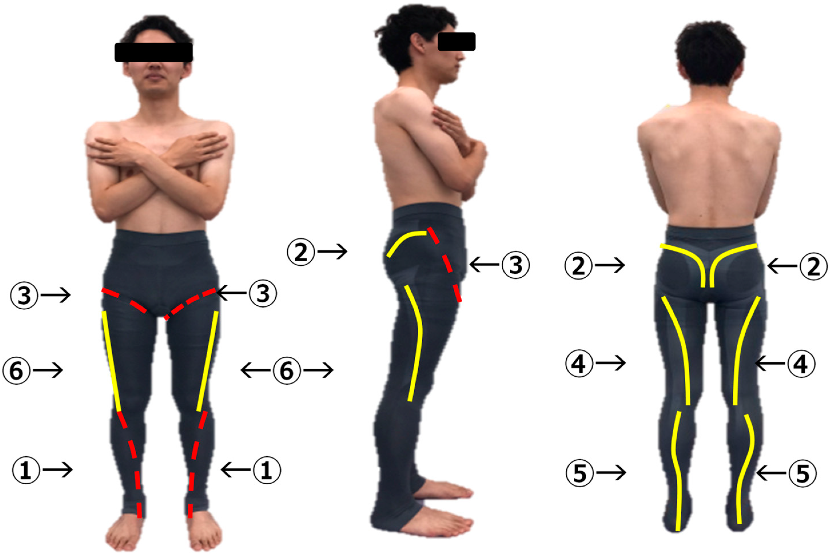 T-25 thigh compression garment to enhances dynamic knee control
