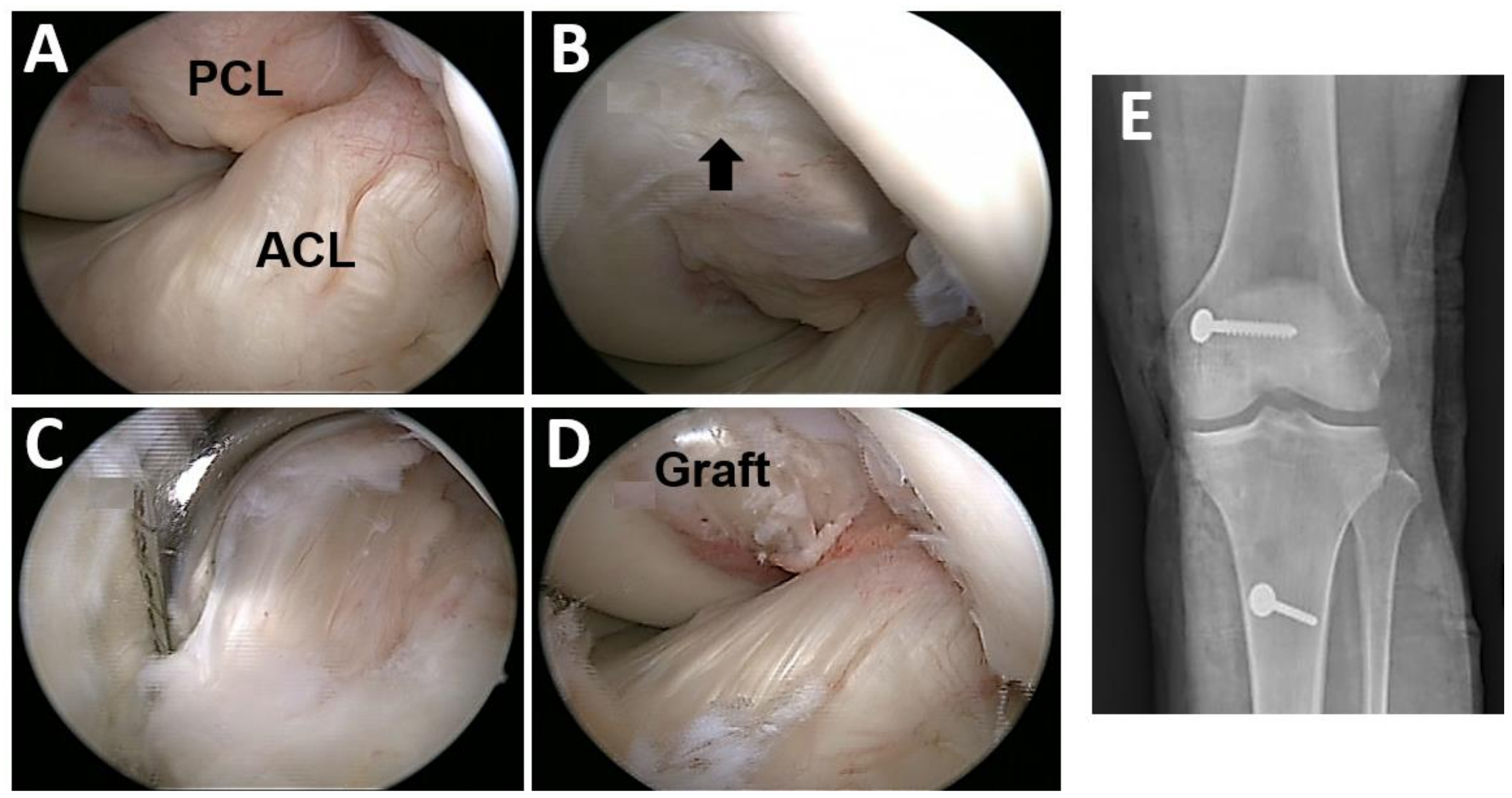 Posterior Cruciate Ligament Injuries image