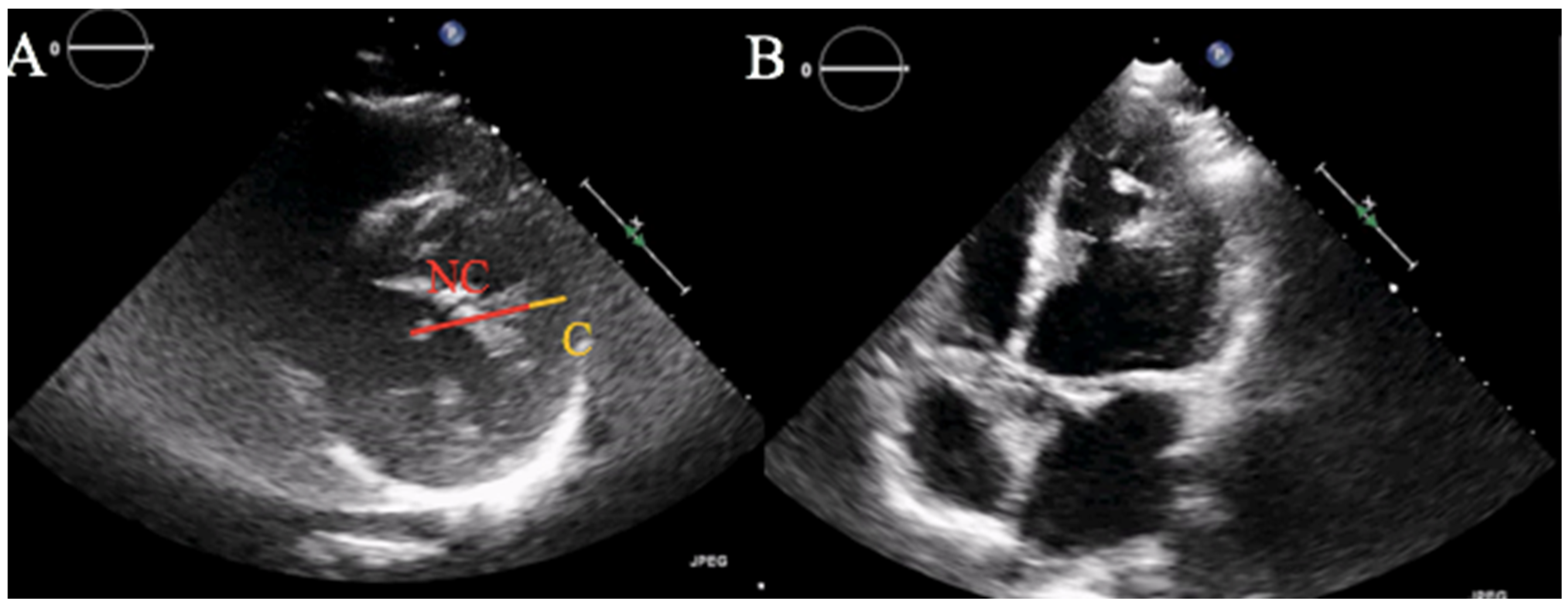Acute on Chronic Heart Failure Secondary to Left Ventricular Noncompaction