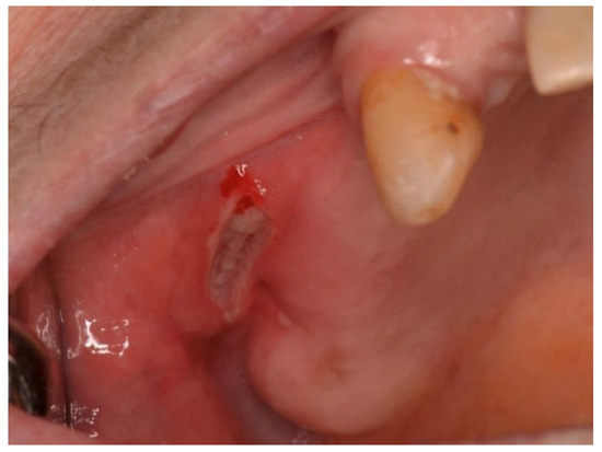 A 7-year retrospective study of biopsied oral lesions in 460