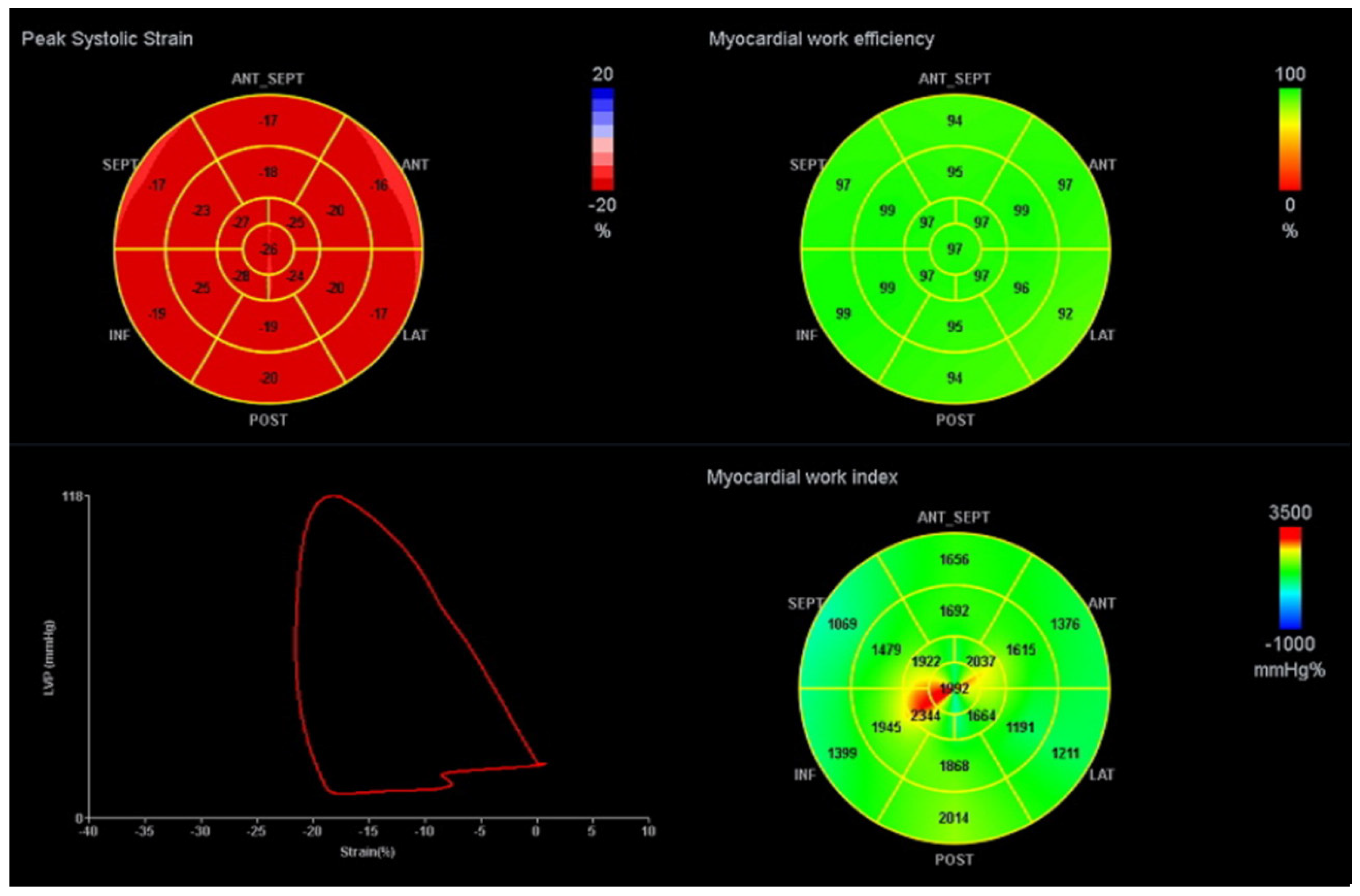 Baseline global longitudinal strain bull's-eye plot of the 16