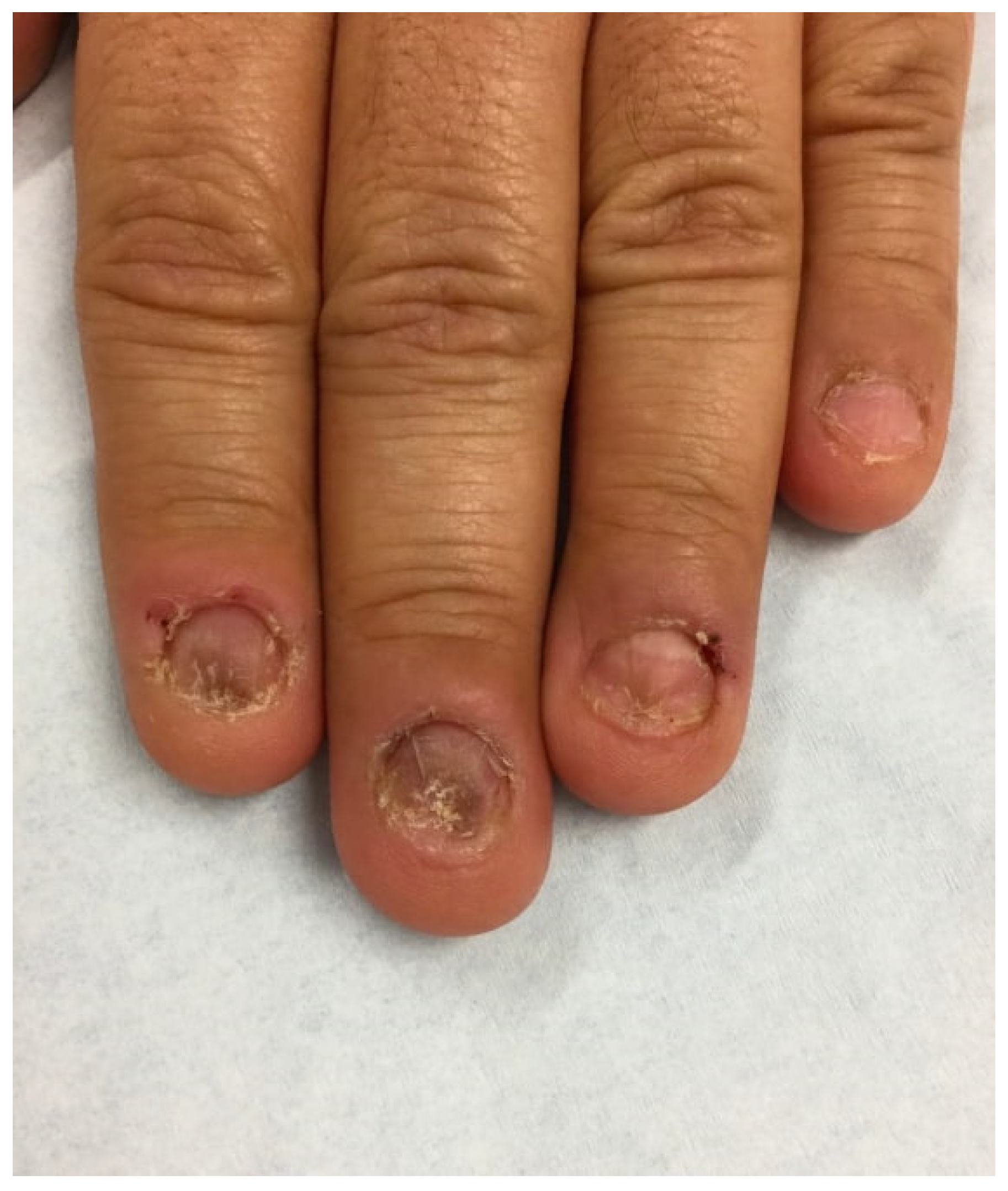 Nail Diseases