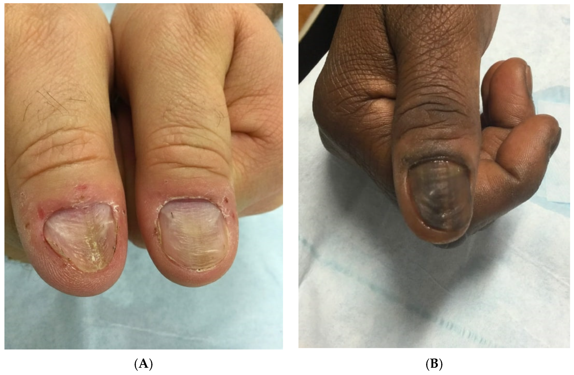 PDF) Dark fingernails