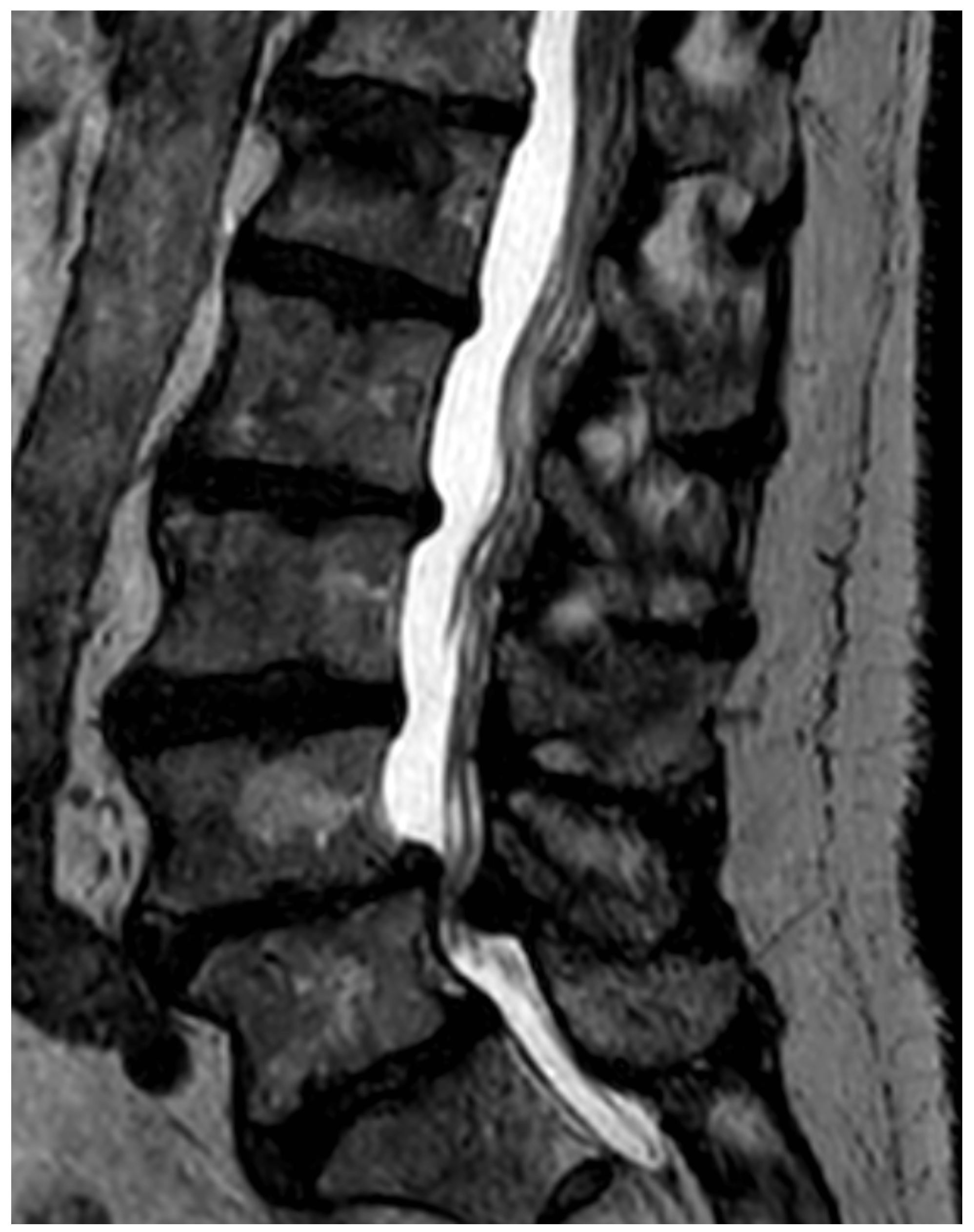 osteochondrosis l4