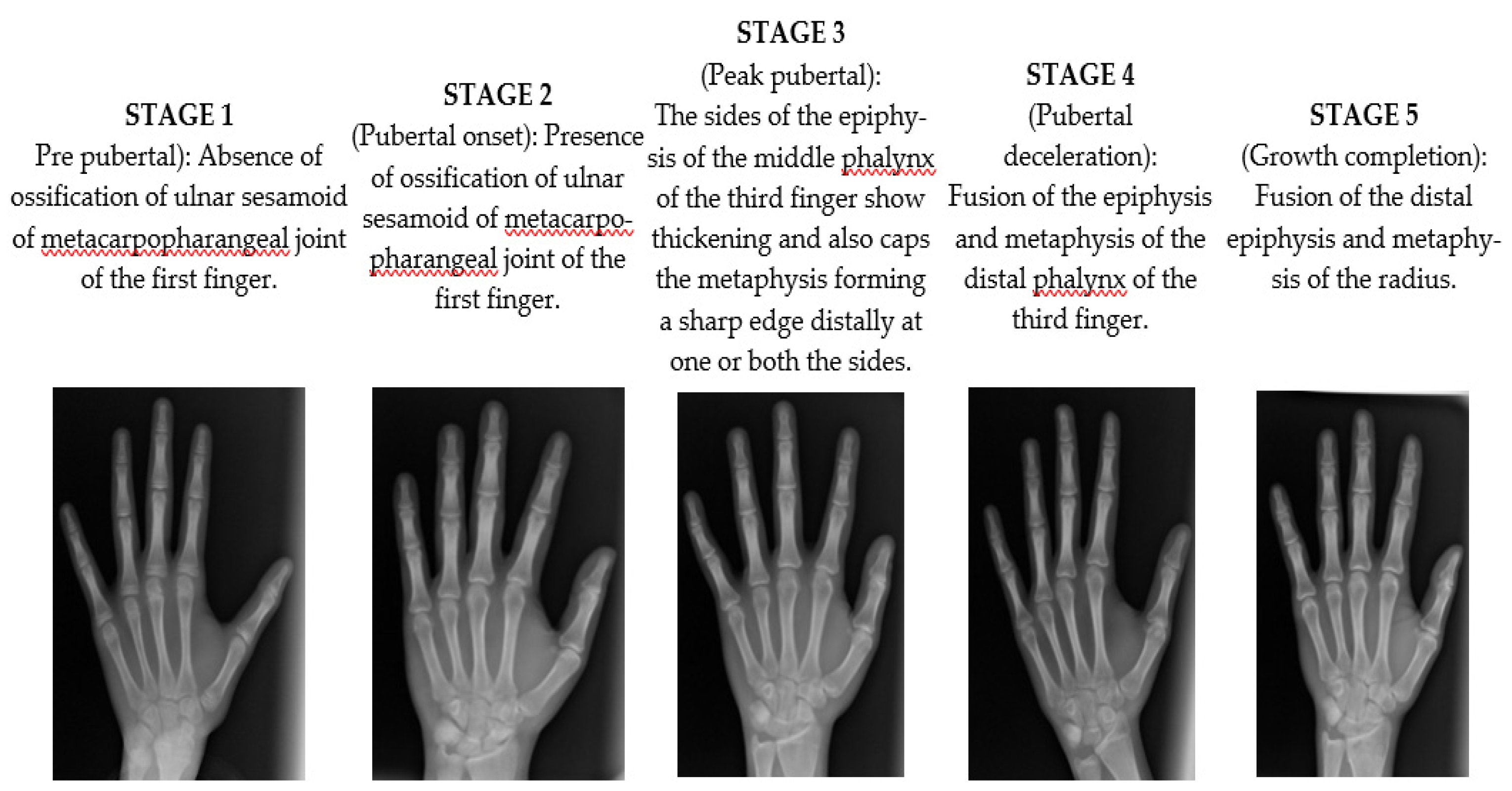 IJERPH Free FullText Correlation between Salivary Levels of IGF1
