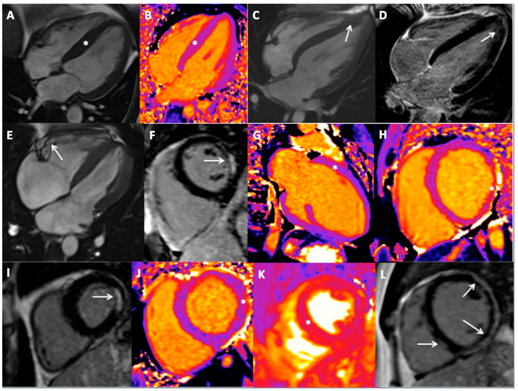 IJERPH Free Full-Text Diagnostic Yield of Cardiac Magnetic Resonance in Athletes with and without Features of the Athleteandrsquo;s Heart and Suspected Structural Heart Disease